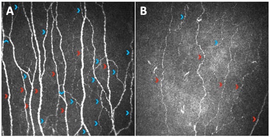 JCM | Free Full-Text | Corneal Confocal Microscopy as a