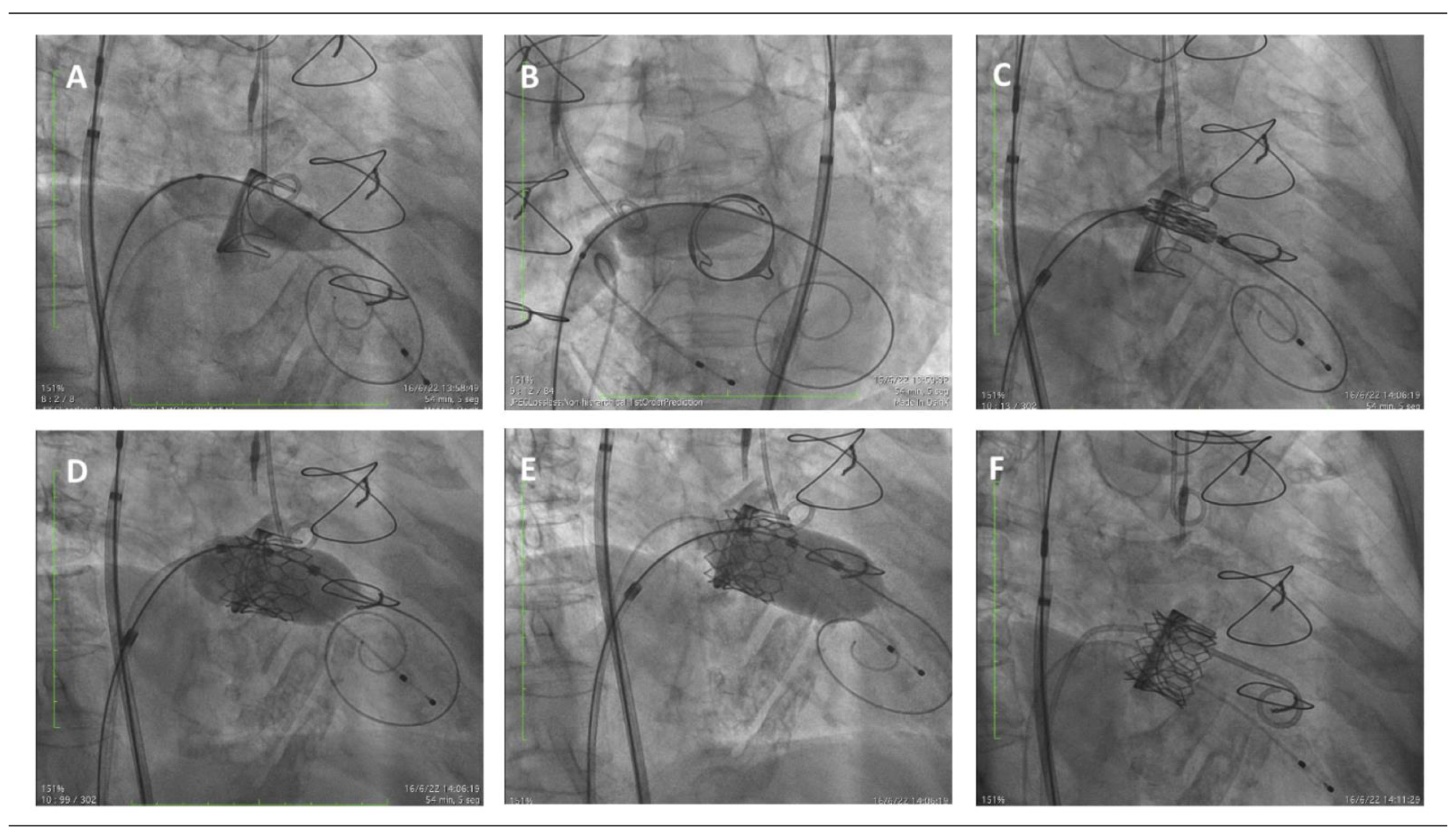 JCM | Free Full-Text | Transcatheter Mitral Valve-in-Valve Implantation  with the Balloon-Expandable Myval Device