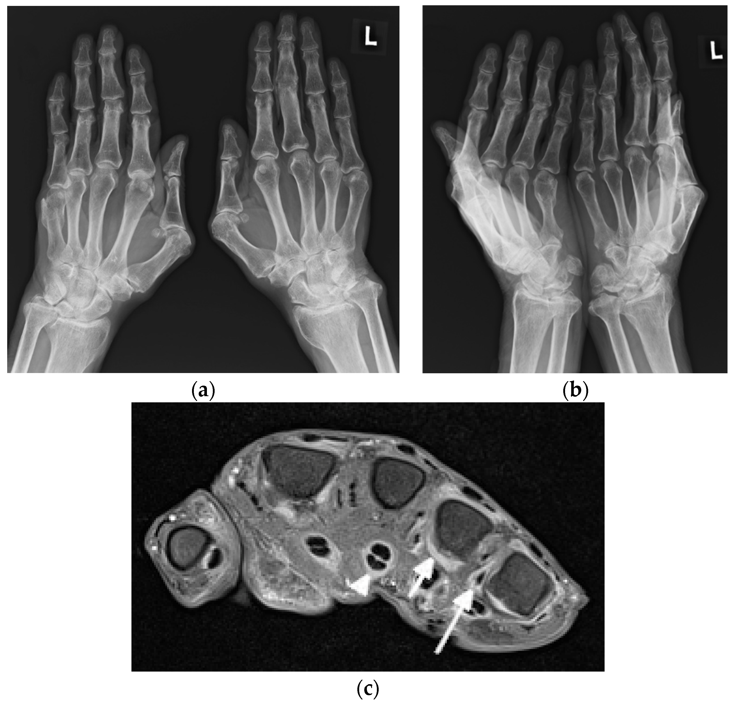 JCM | Free Full-Text | Update on Current Imaging of Systemic Lupus  Erythematous in Adults and Juveniles