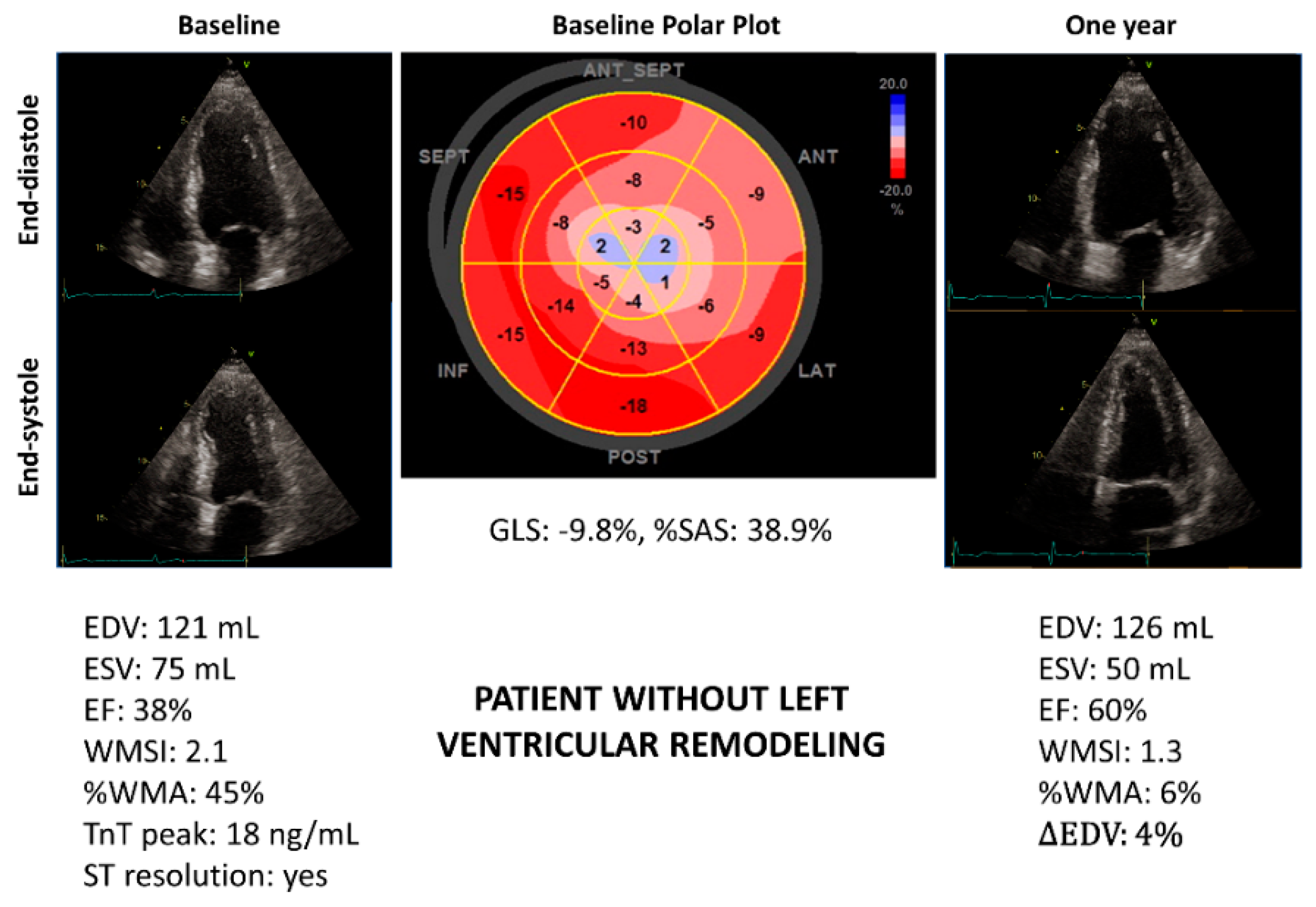 Figure 1 from Global longitudinal speckle-tracking strain is predictive of  left ventricular remodeling after coronary angioplasty in patients with  recent non-ST elevation myocardial infarction.