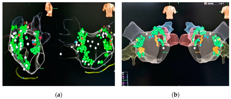 Tilt Test - AF-ABLATION