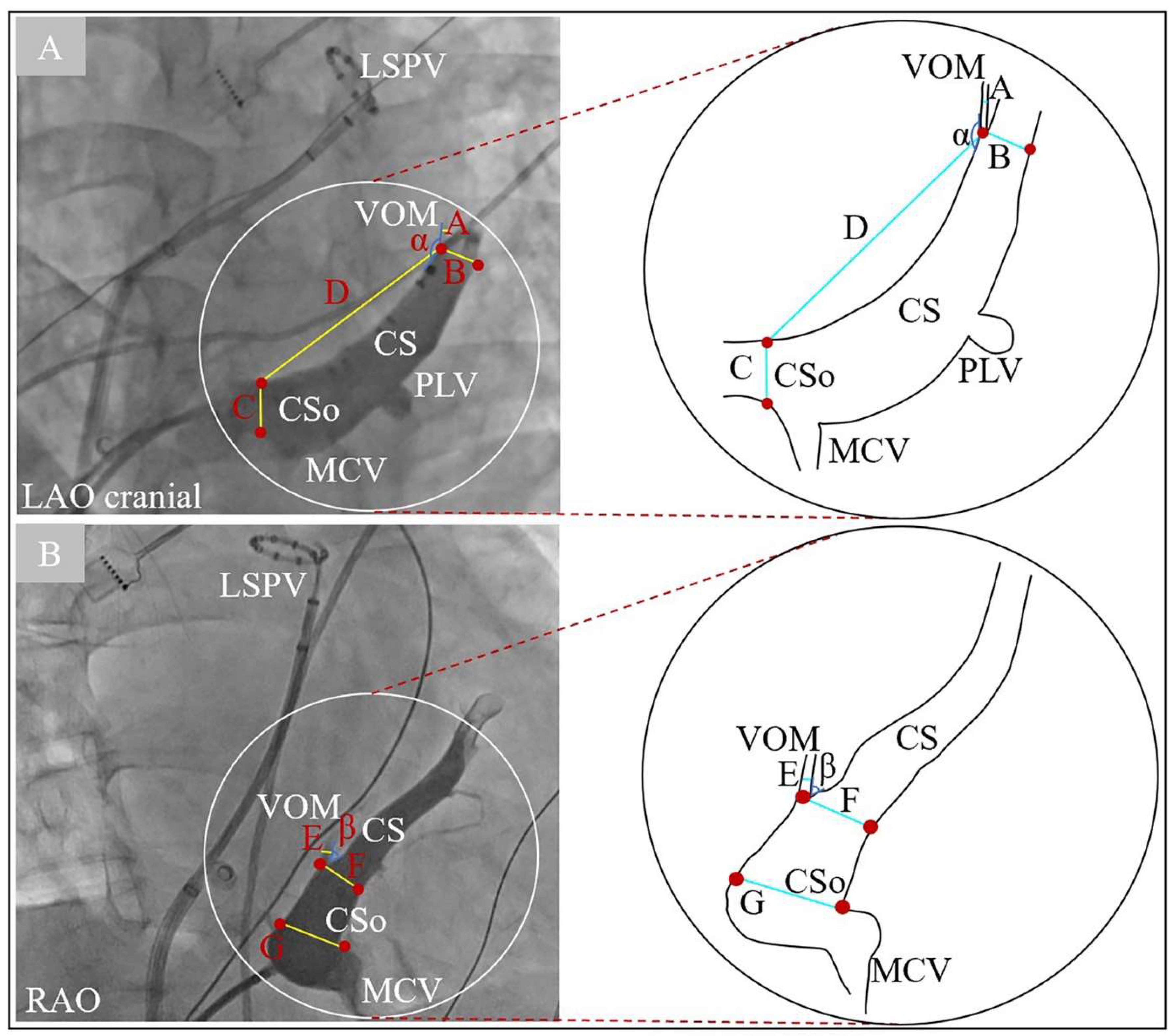 JCM | Free Full-Text | Angiographic Characteristics of the Vein of Marshall  in Patients with and without Atrial Fibrillation
