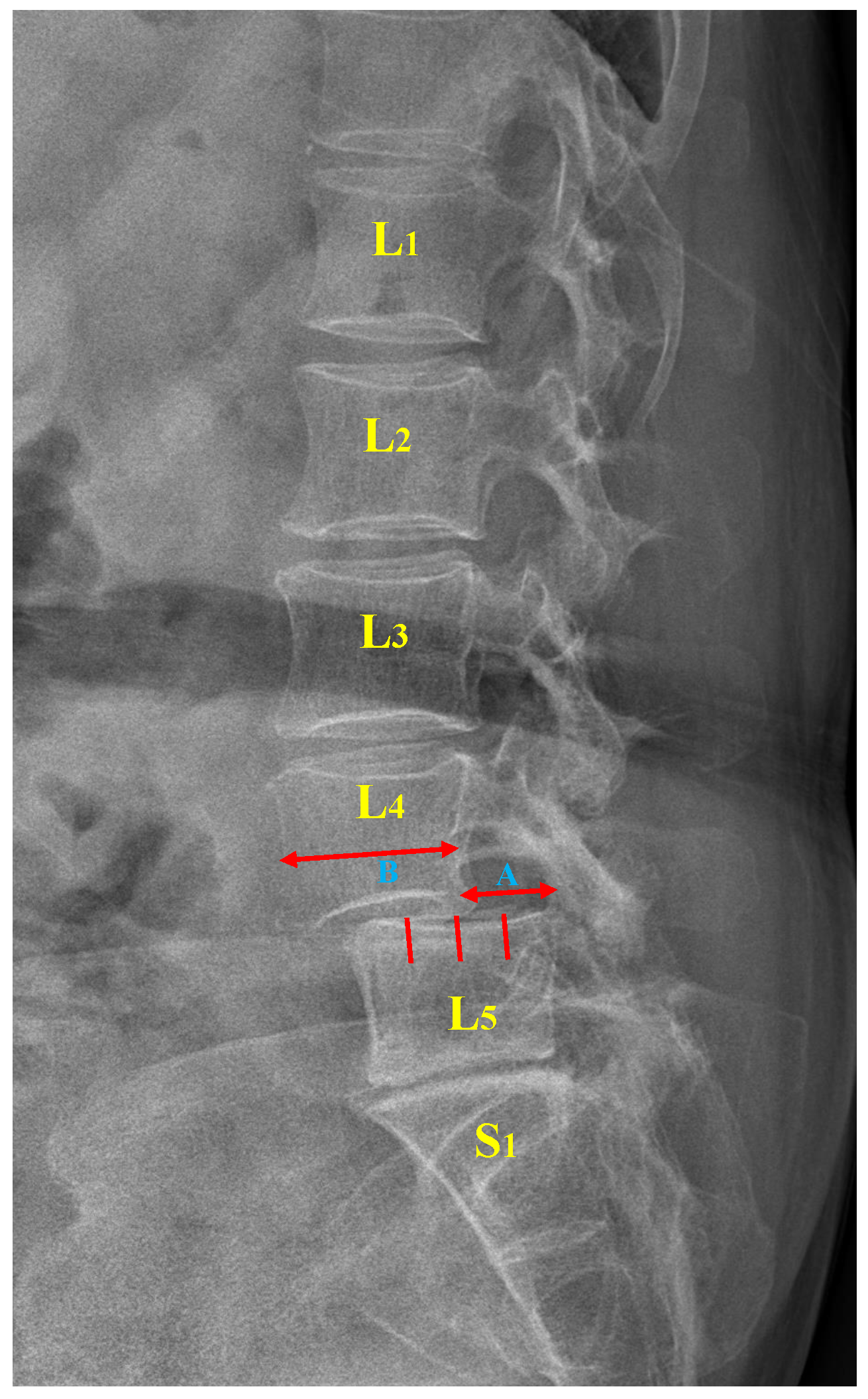 Inferior lumbar triangle, Radiology Reference Article