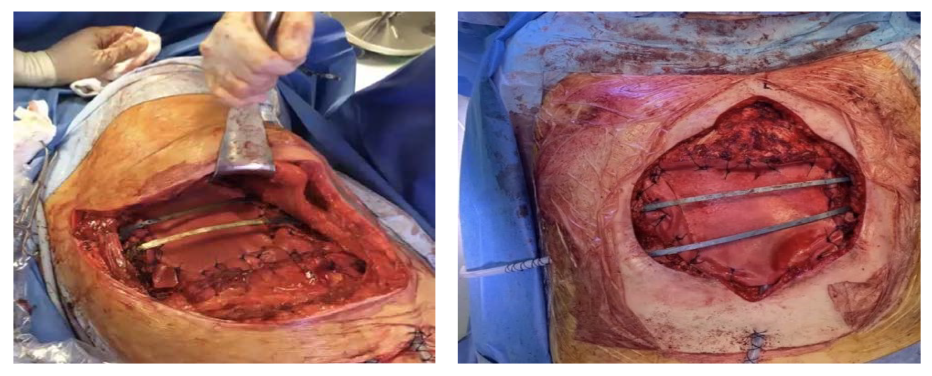 A) Chest wall defect after complete resection of the piece, with