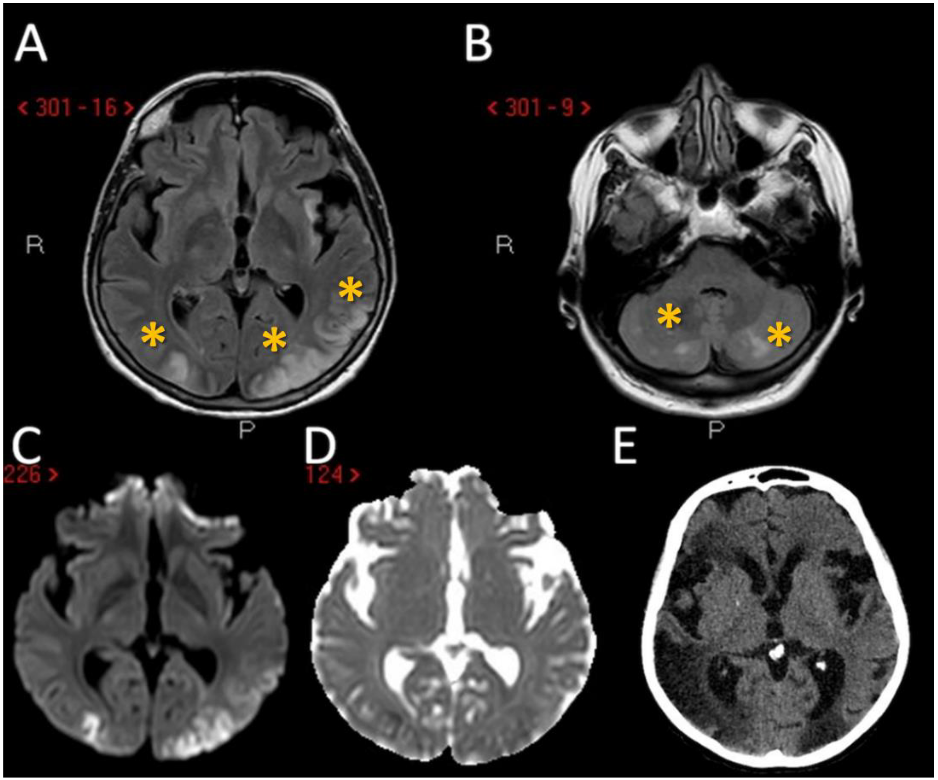 JCM | Free Full-Text | Mechanisms and Neuroimaging Patterns of ...