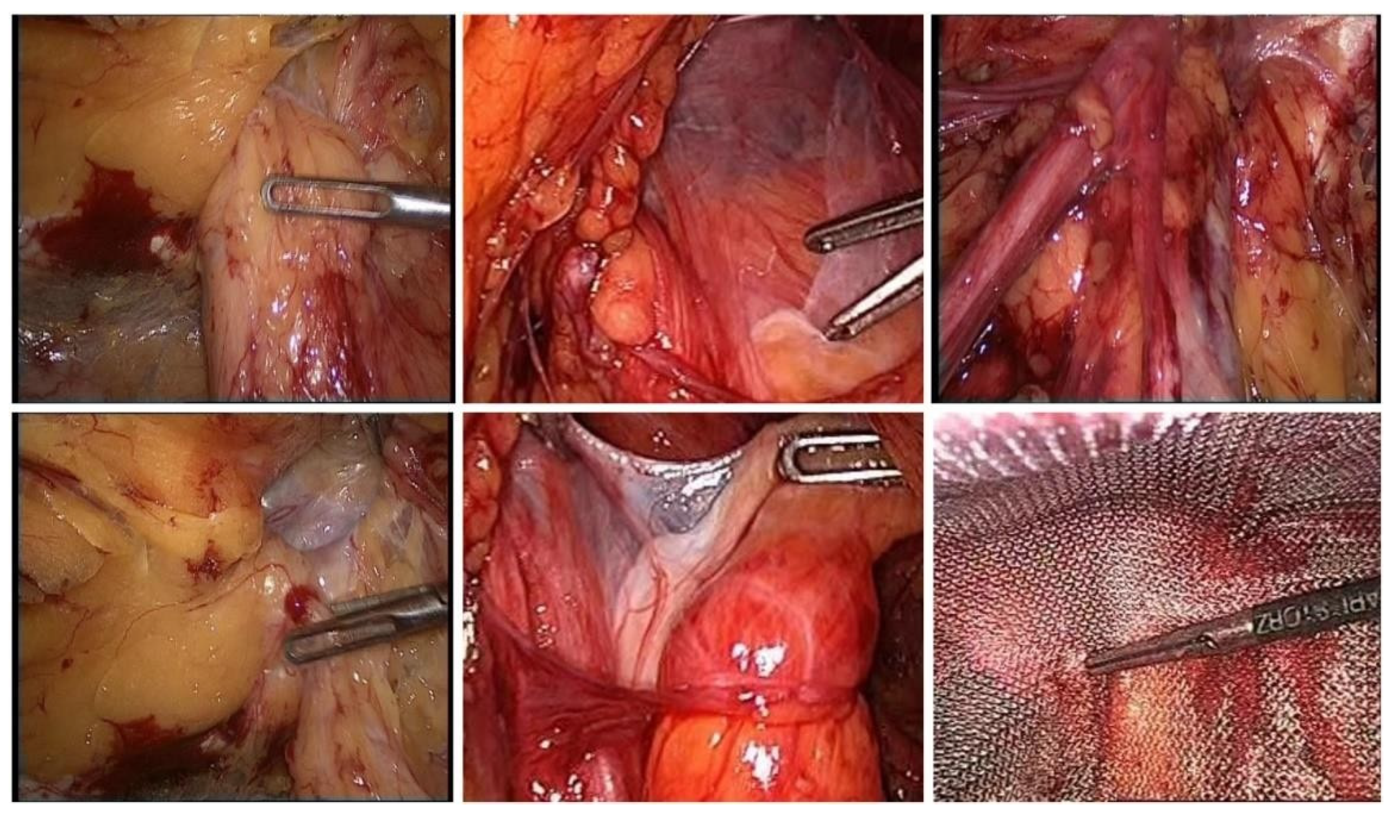 Laparoscopic repair of an incarcerated femoral hernia. - Abstract
