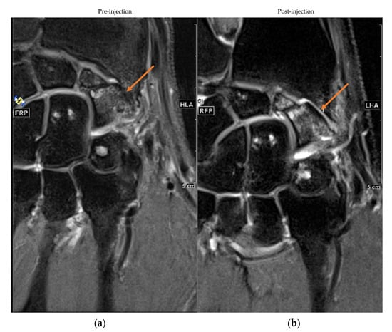 JCM | Free Full-Text | Intra Articular Injection of Autologous Microfat ...