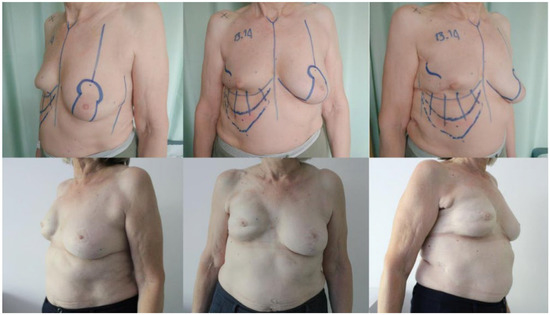 JCM | Free Full-Text | Sub-Muscular Direct-to-Implant Immediate Breast  Reconstruction in Previously Irradiated Patients Avoiding the Use of ADM: A  Preliminary Study | HTML