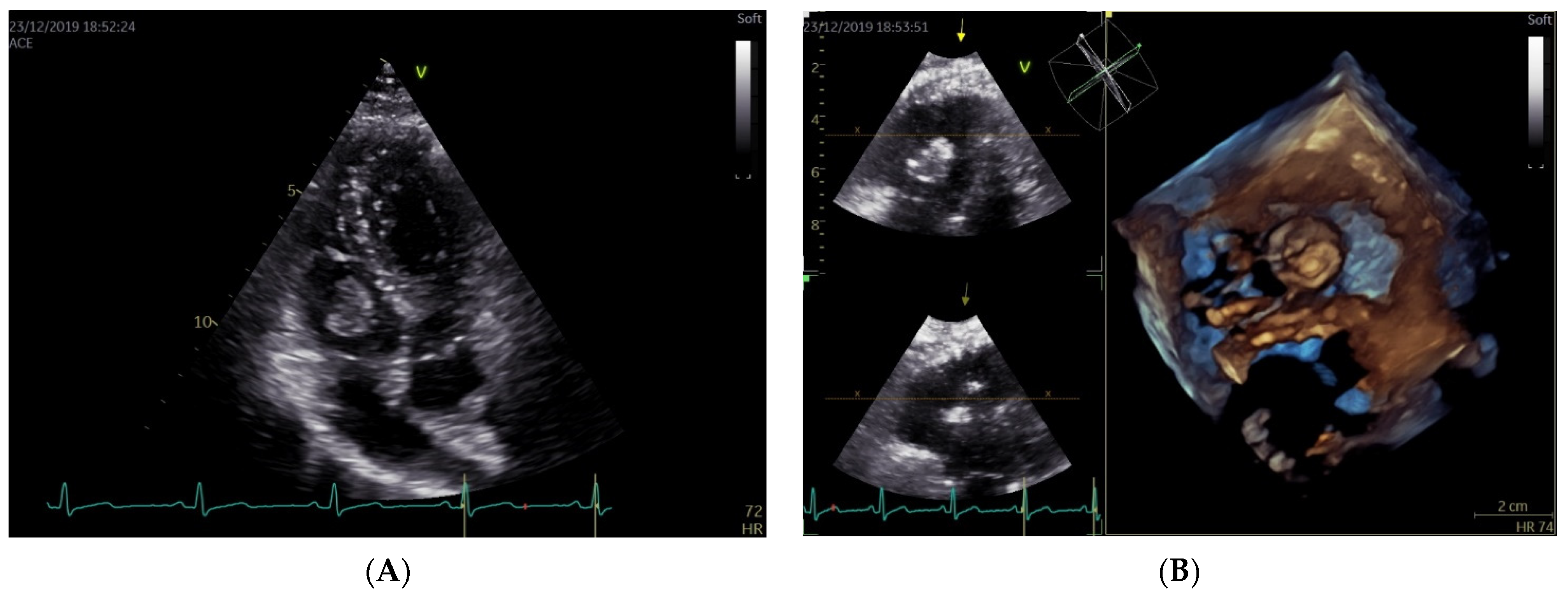 JCM | Free Full-Text | A Rare Case of Tricuspid Valve Libman&ndash;Sacks  Endocarditis in a Pregnant Woman with Primary Antiphospholipid Syndrome