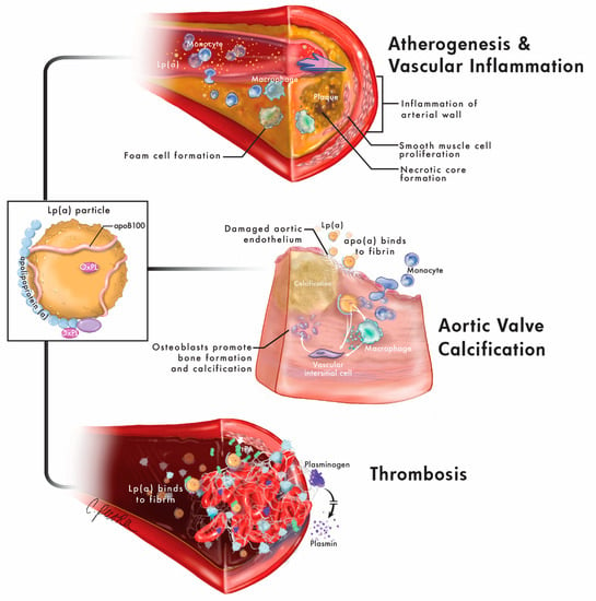 JCM | Free Full-Text | Lipoprotein(a): Evidence for Role as a