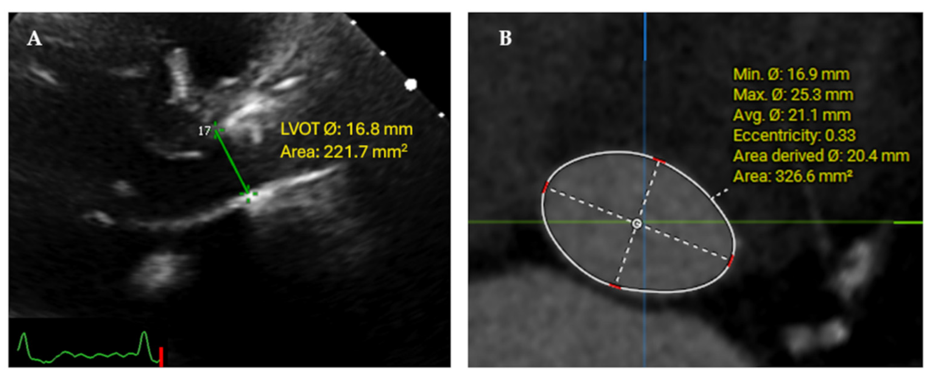 JCM | Free Full-Text | Core Lab Adjudication of the ACURATE neo2  Hemodynamic Performance Using Computed-Tomography-Corrected Left  Ventricular Outflow Tract Area
