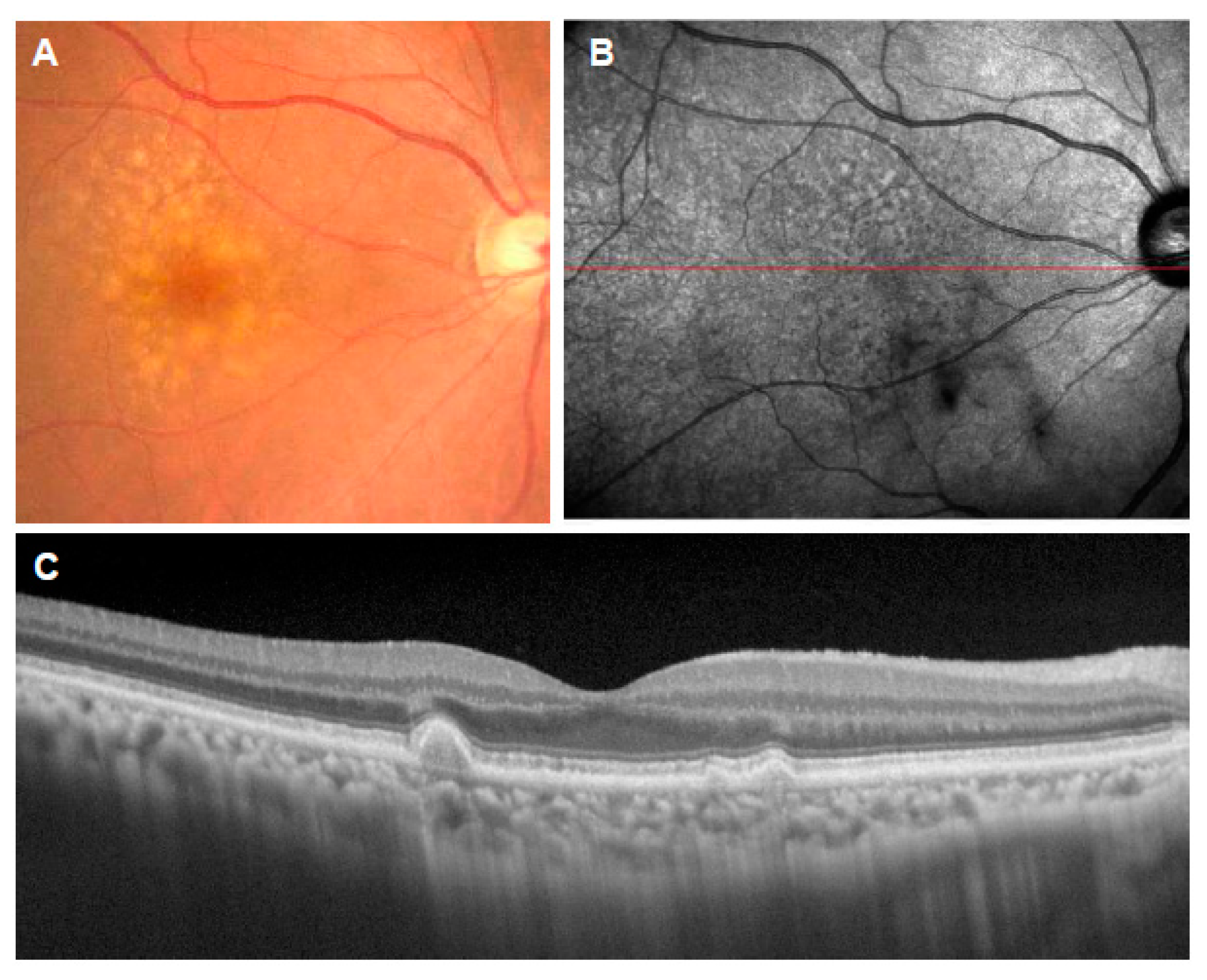 JCM | Free Full-Text | Early Stages of Age-Related Macular Degeneration ...