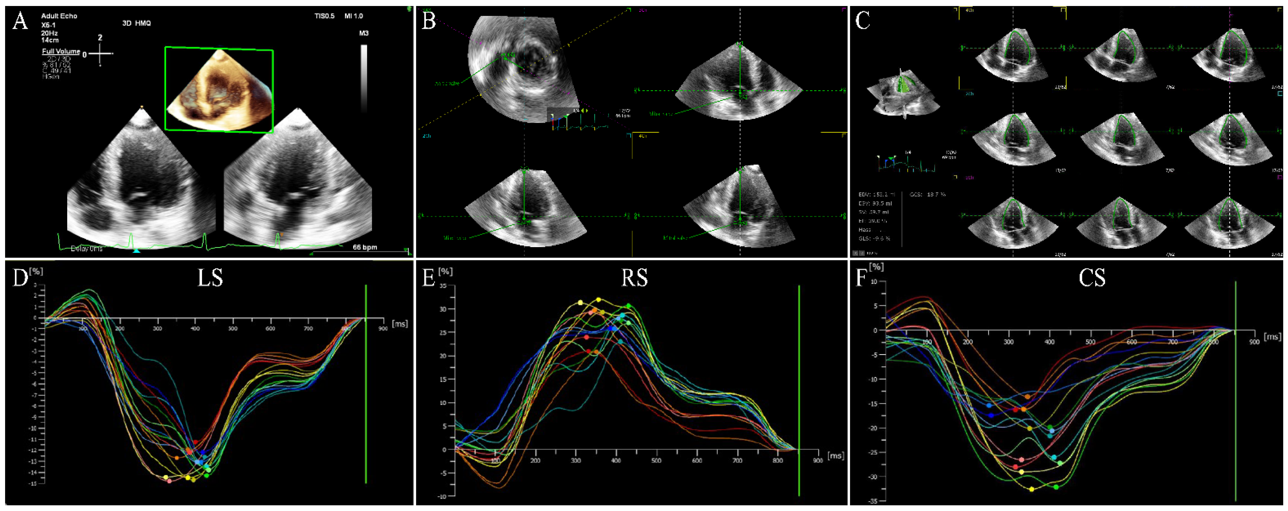 Speckle tracking echocardiography to assess regional ventricular function  in patients with apical hypertrophic cardiomyopathy