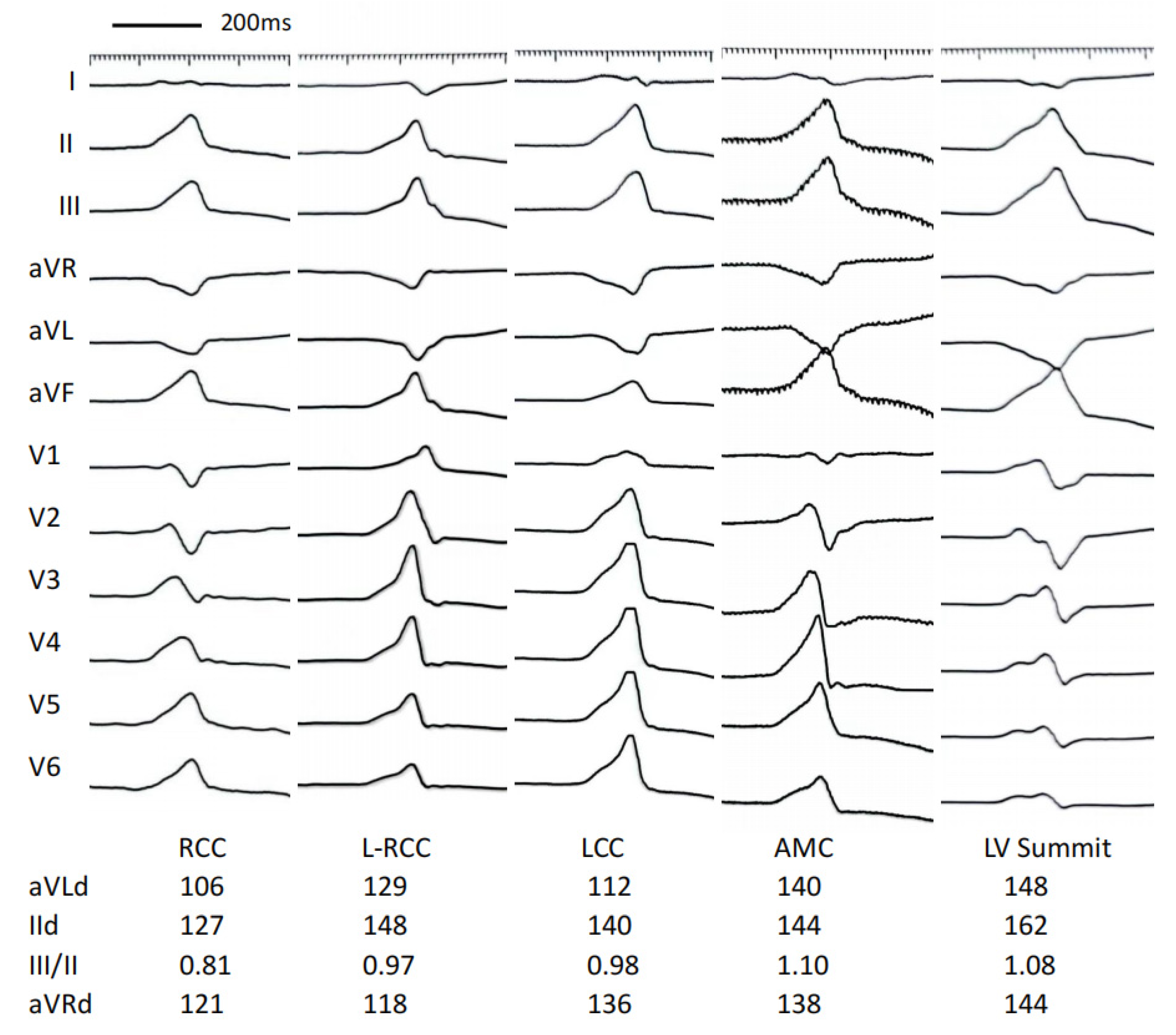 Stepwise ECG algorithm for the determination of the location of the