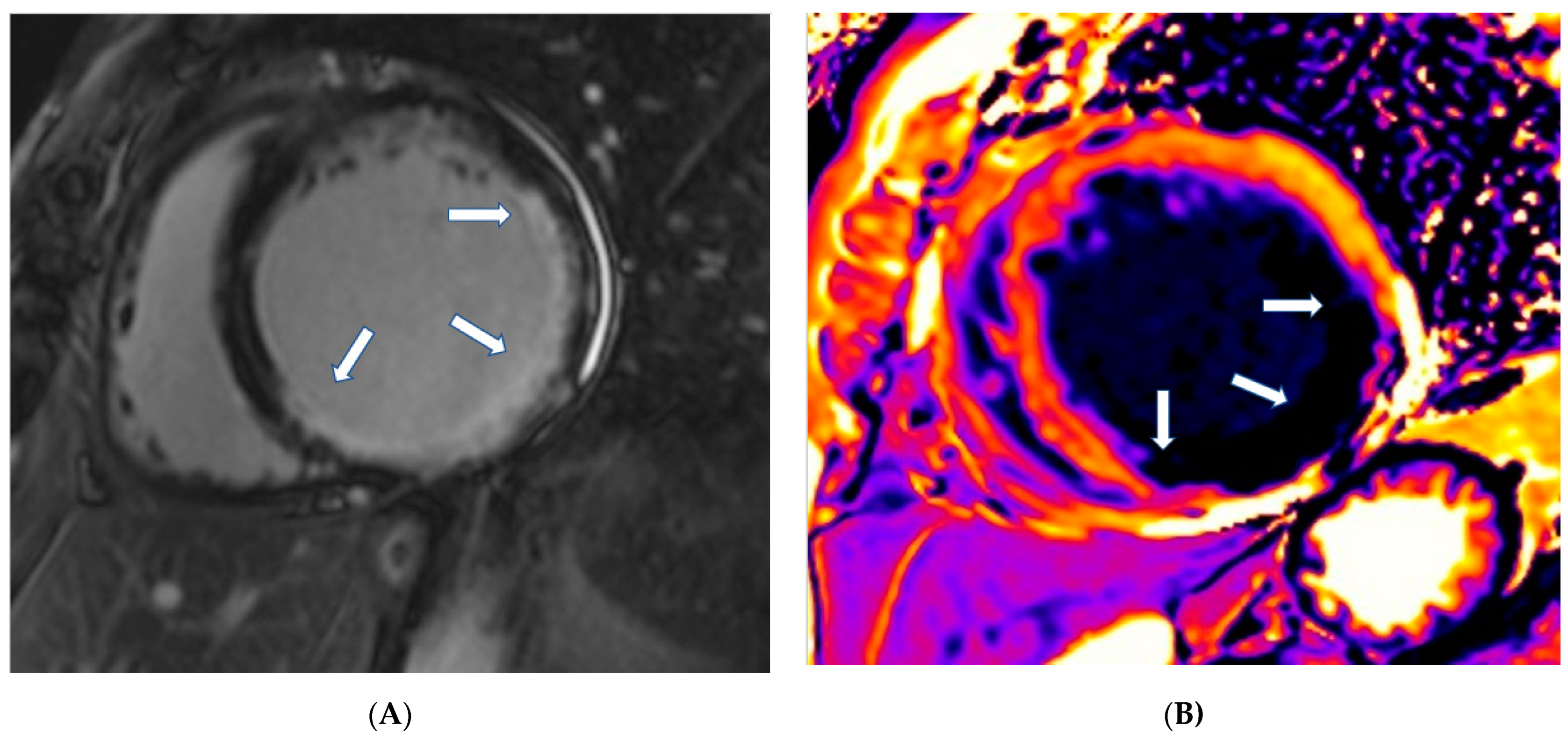 T2 Relaxation Times at Cardiac MRI in Healthy Adults: A Systematic