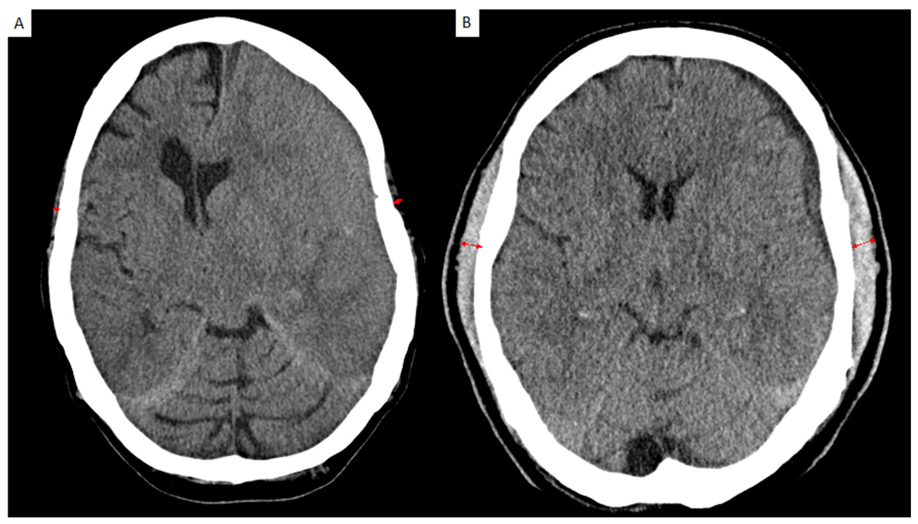 Jcm Free Full Text Significance Of Temporal Muscle Thickness In Chronic Subdural Hematoma 9550