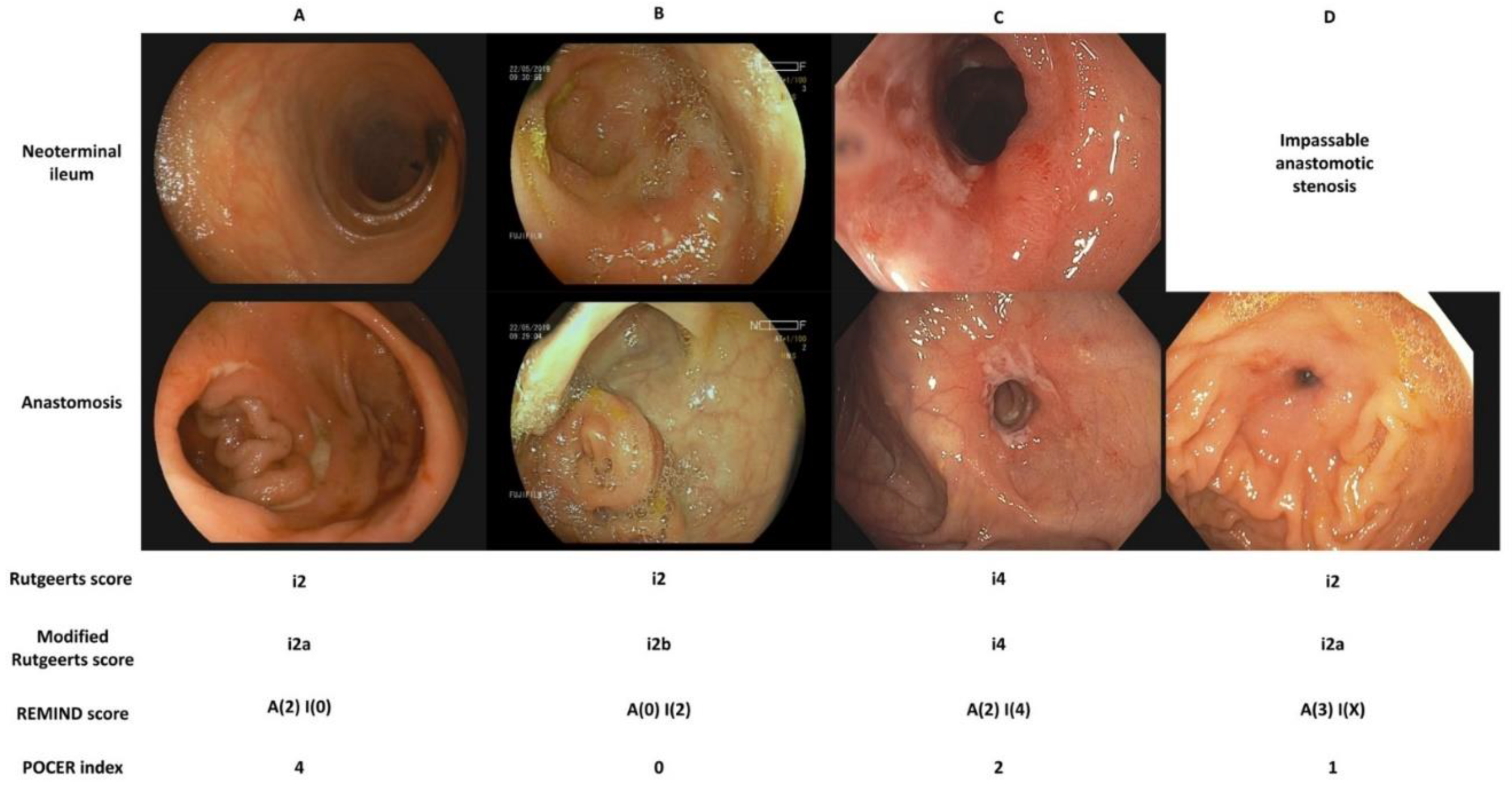 JCM | Free Full-Text | Contemporary Management of Postoperative  Crohn&rsquo;s Disease after Ileocolonic Resection