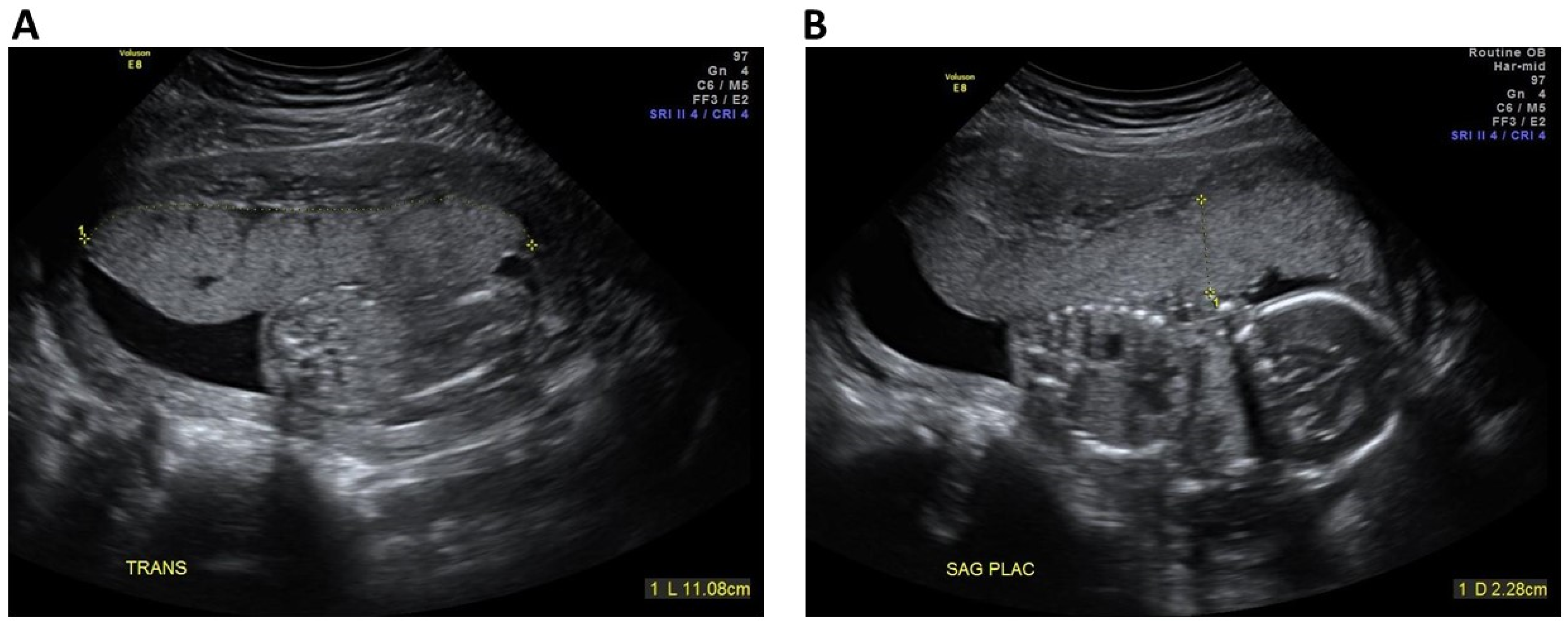 JCM | Free Full-Text | Contribution of Second Trimester Sonographic  Placental Morphology to Uterine Artery Doppler in the Prediction of Placenta-Mediated  Pregnancy Complications