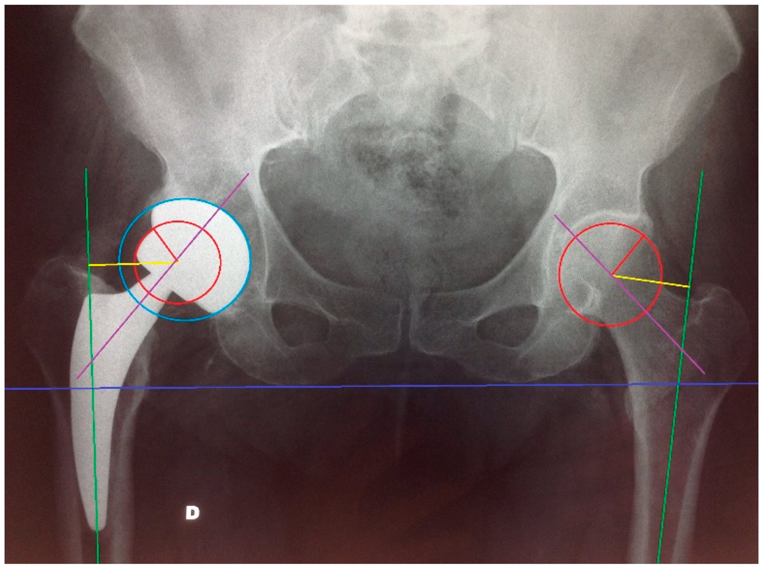 Mike Napoli has avascular necrosis in his hips 