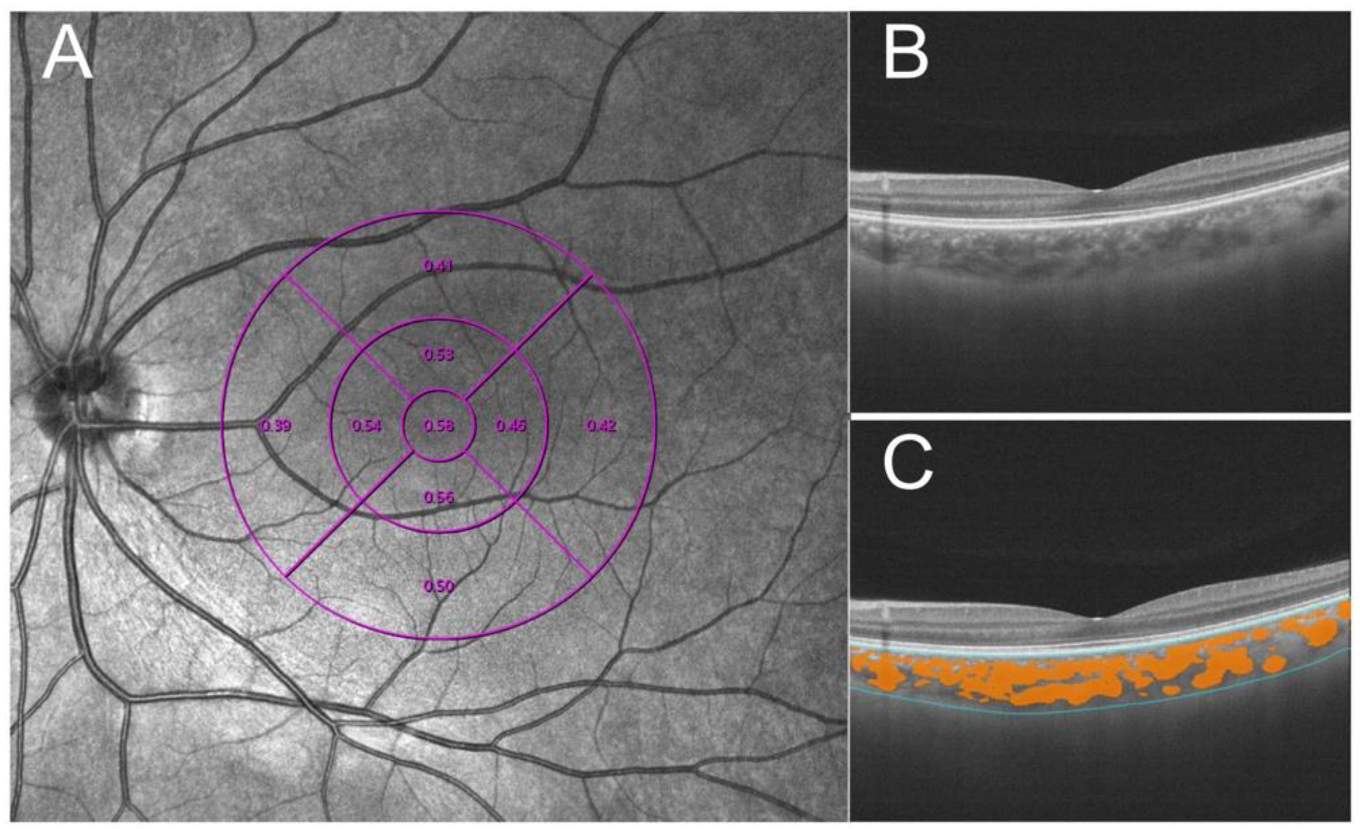 Myopia: Repeated low-level red-light therapy