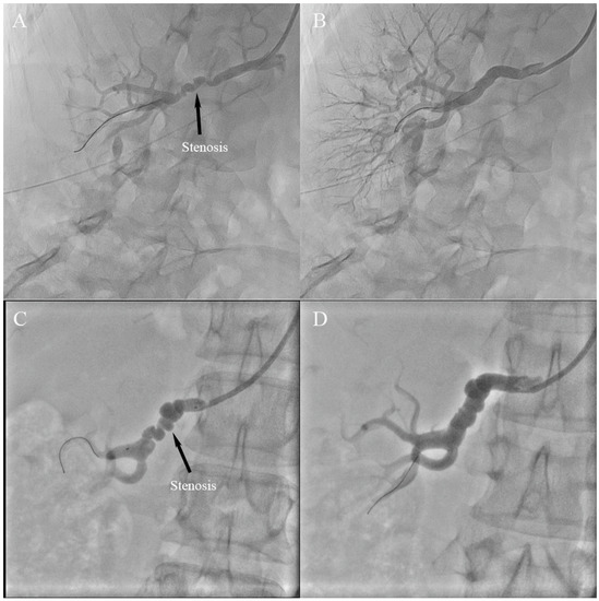 Jcm Free Full Text Percutaneous Transluminal Renal Angioplasty For