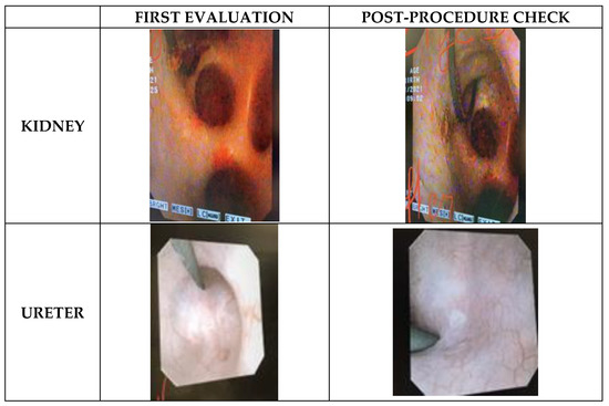 Table 1 from Alternative Treatment of Osteoma Using an Endoscopic  Holmium-YAG Laser