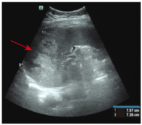 The vaginal metastasis choriocarcinoma, which contained blood clots