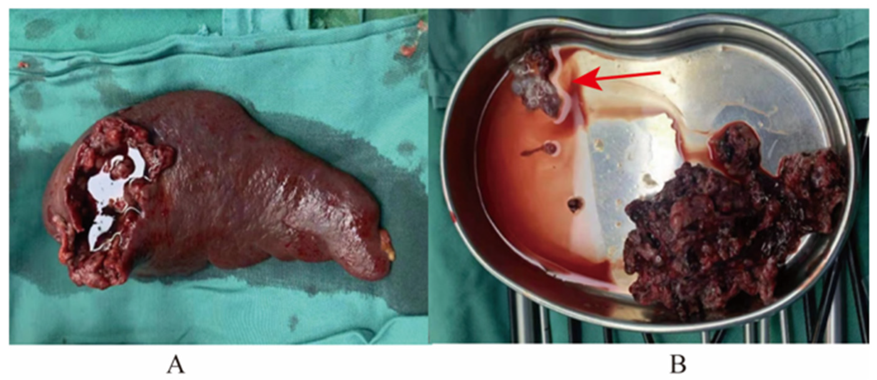 The vaginal metastasis choriocarcinoma, which contained blood clots