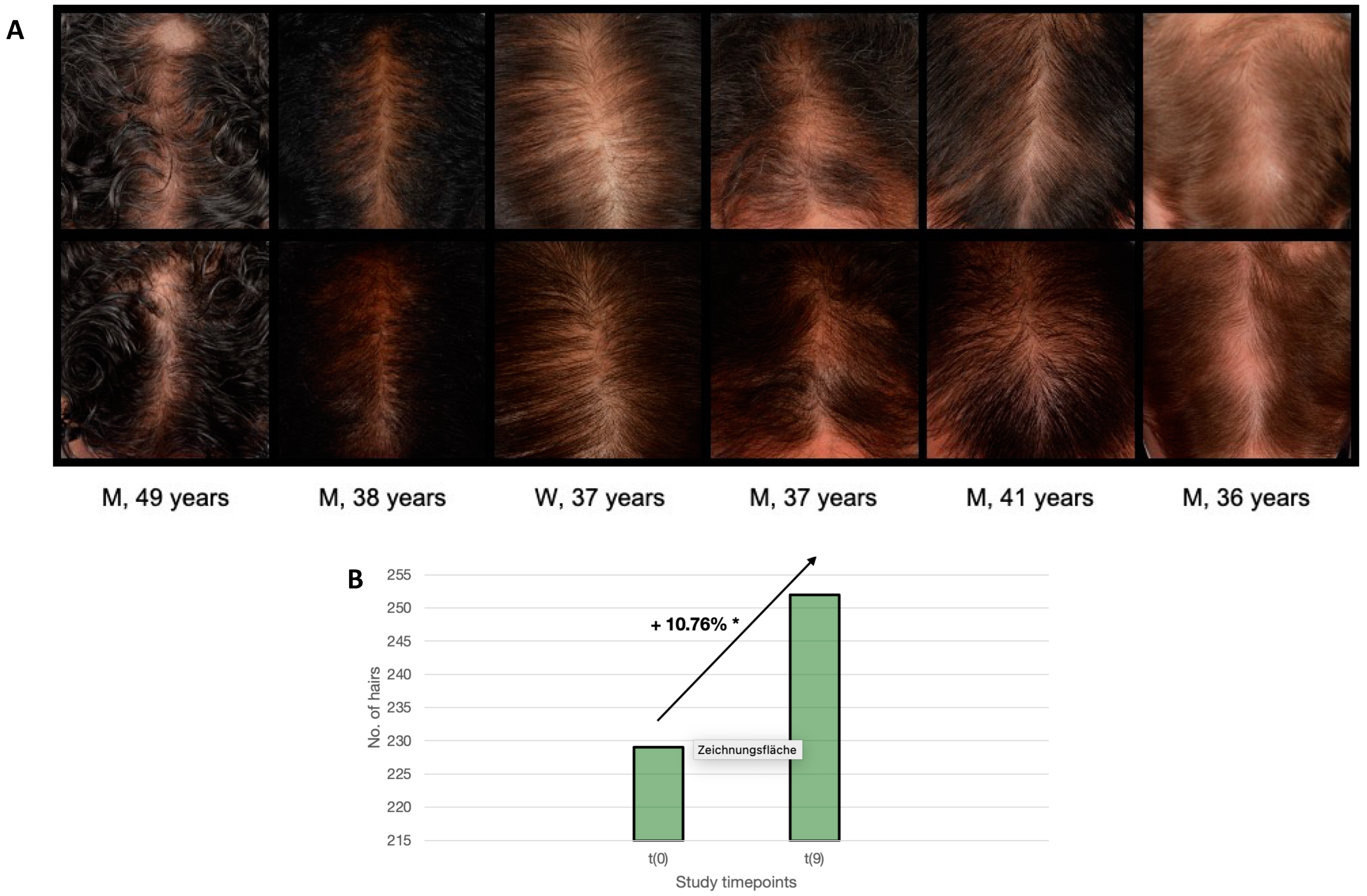 JCM | Free Full-Text | A Novel Hair Restoration Technology Counteracts  Androgenic Hair Loss and Promotes Hair Growth in A Blinded Clinical Trial