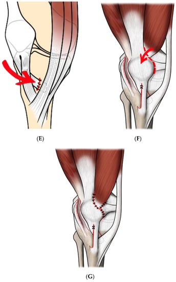 Patellar instability can be classified into four types based on