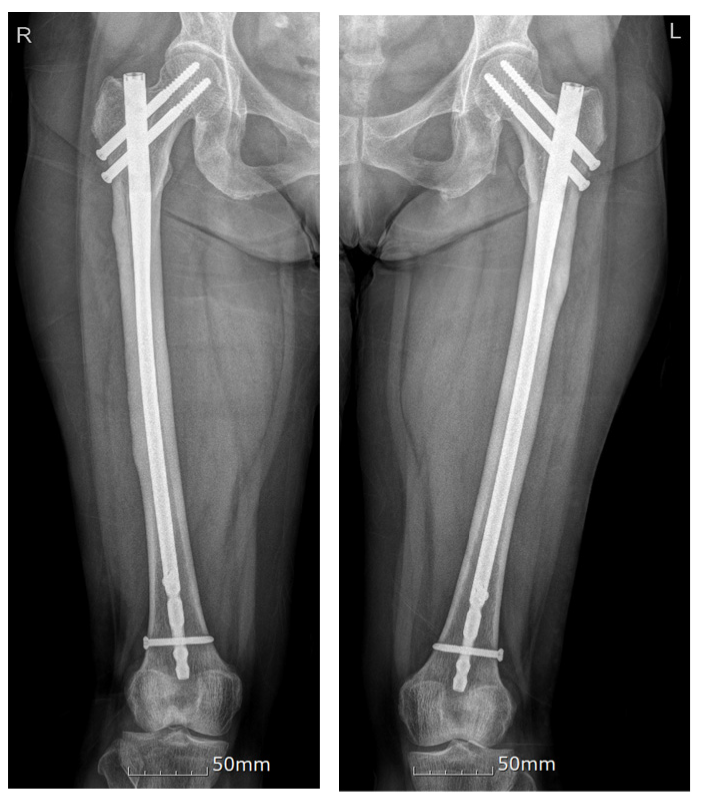 Jcm Free Full Text Bilateral Atypical Femoral Fractures After