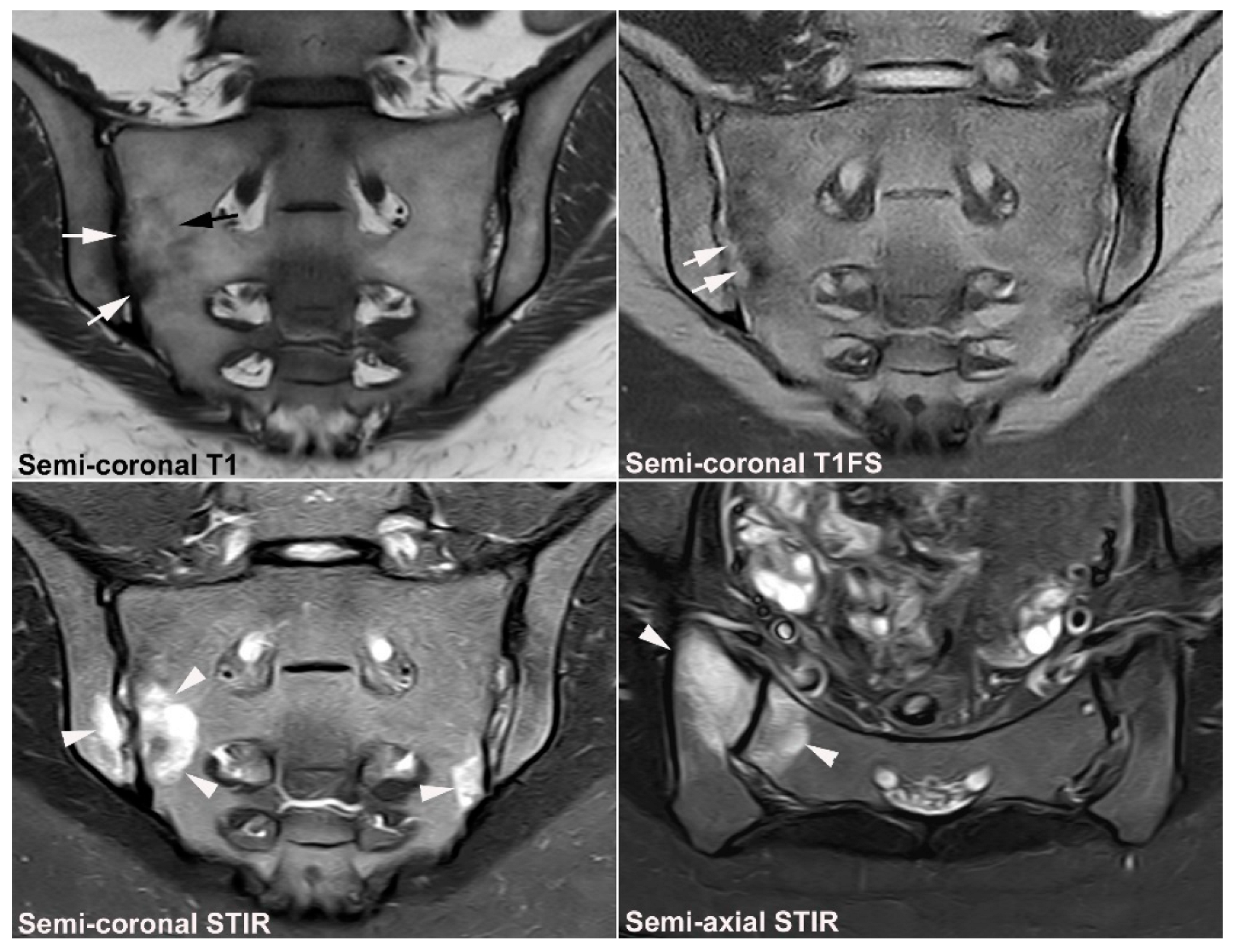 JCM | Free Full-Text | Diagnostics of Sacroiliac Joint Differentials to  Axial Spondyloarthritis Changes by Magnetic Resonance Imaging