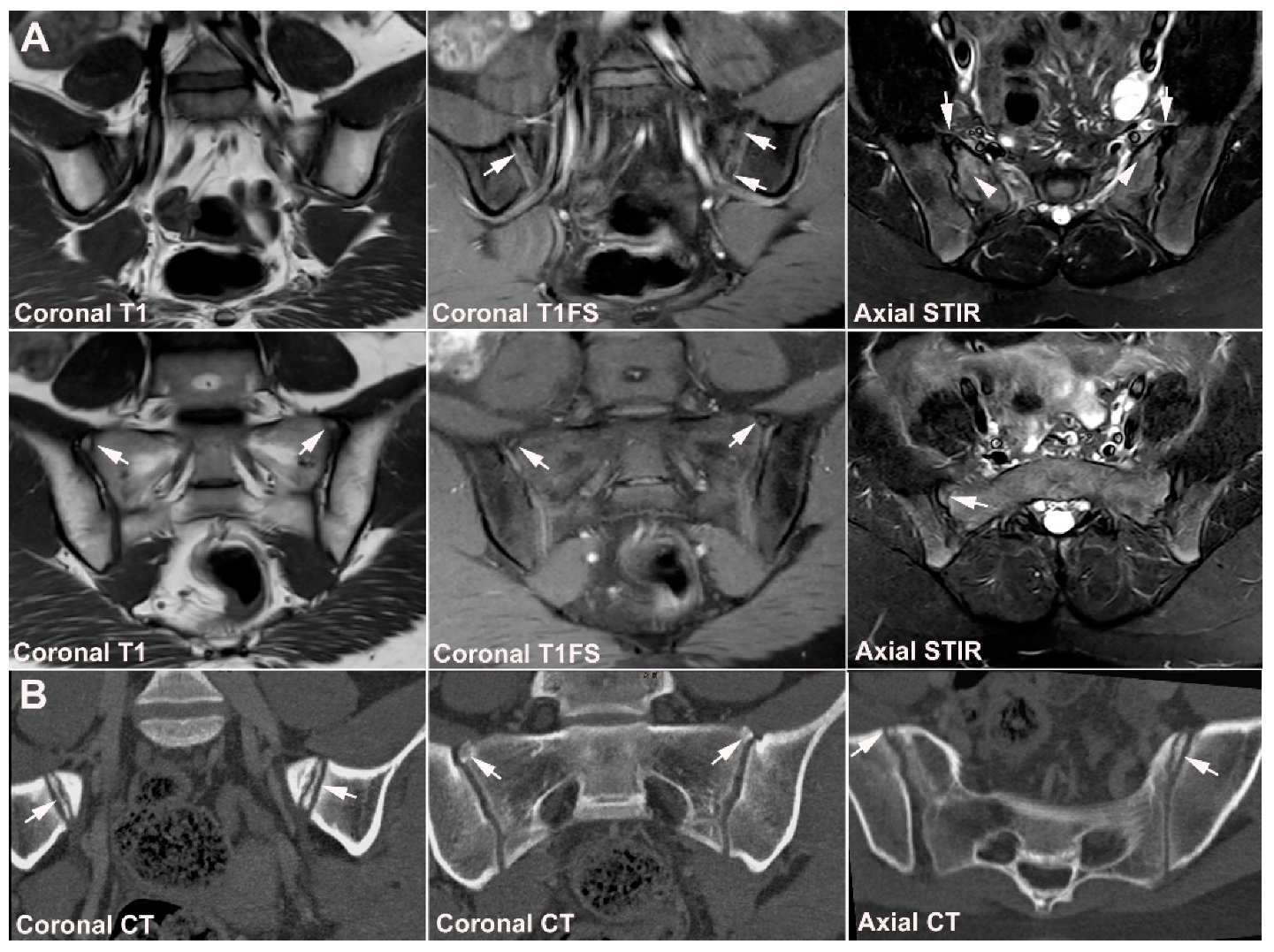 Jcm Free Full Text Diagnostics Of Sacroiliac Joint Differentials To Axial Spondyloarthritis 7441