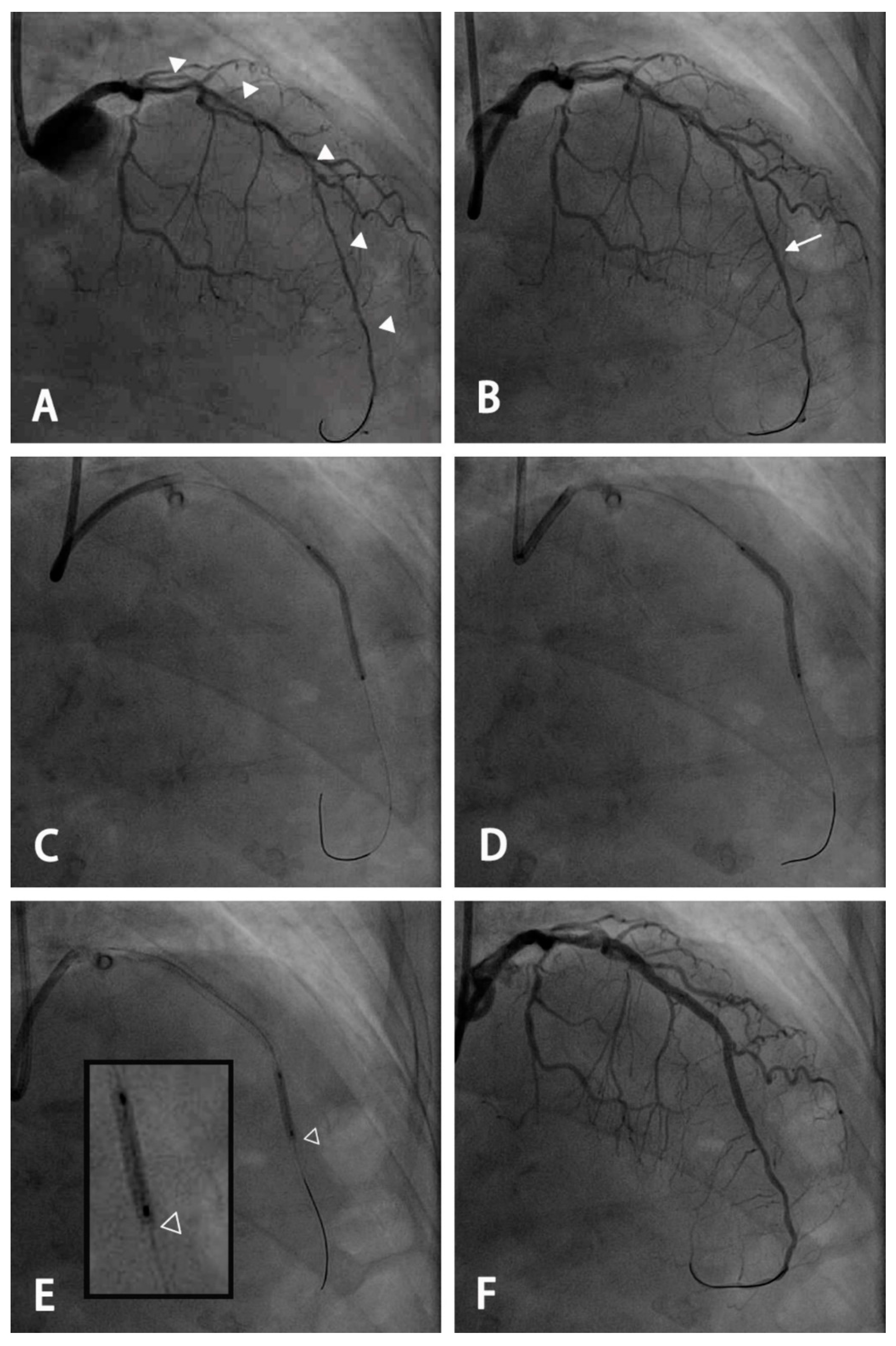 JCM | Free Full-Text | Outcomes of Percutaneous Coronary Interventions for  Long Diffuse Coronary Artery Disease with Extremely Small Diameter