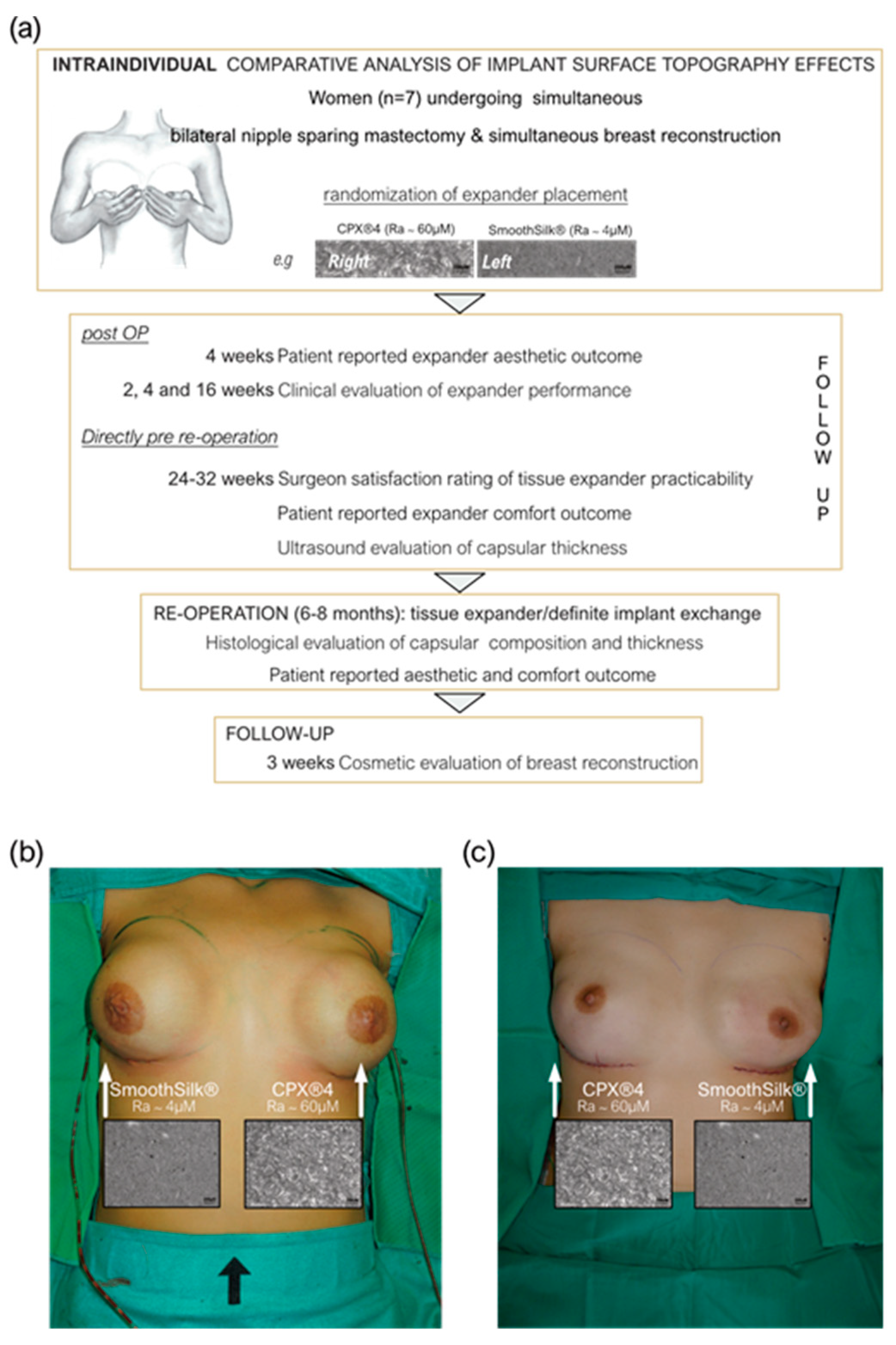 JCM | Free Full-Text | Is It All about Surface Topography? An  Intra-Individual Clinical Outcome Analysis of Two Different Implant  Surfaces in Breast Reconstruction