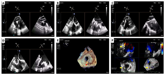 JCM | Free Full-Text | Transcatheter Tricuspid Valve Replacement ...