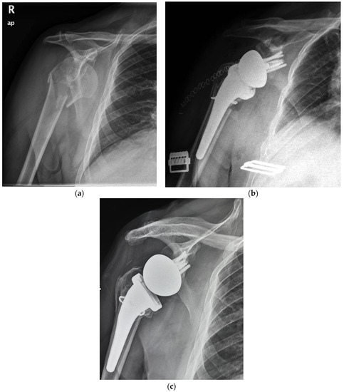 JCM | Free Full-Text | Reverse Total Shoulder Arthroplasty with a ...