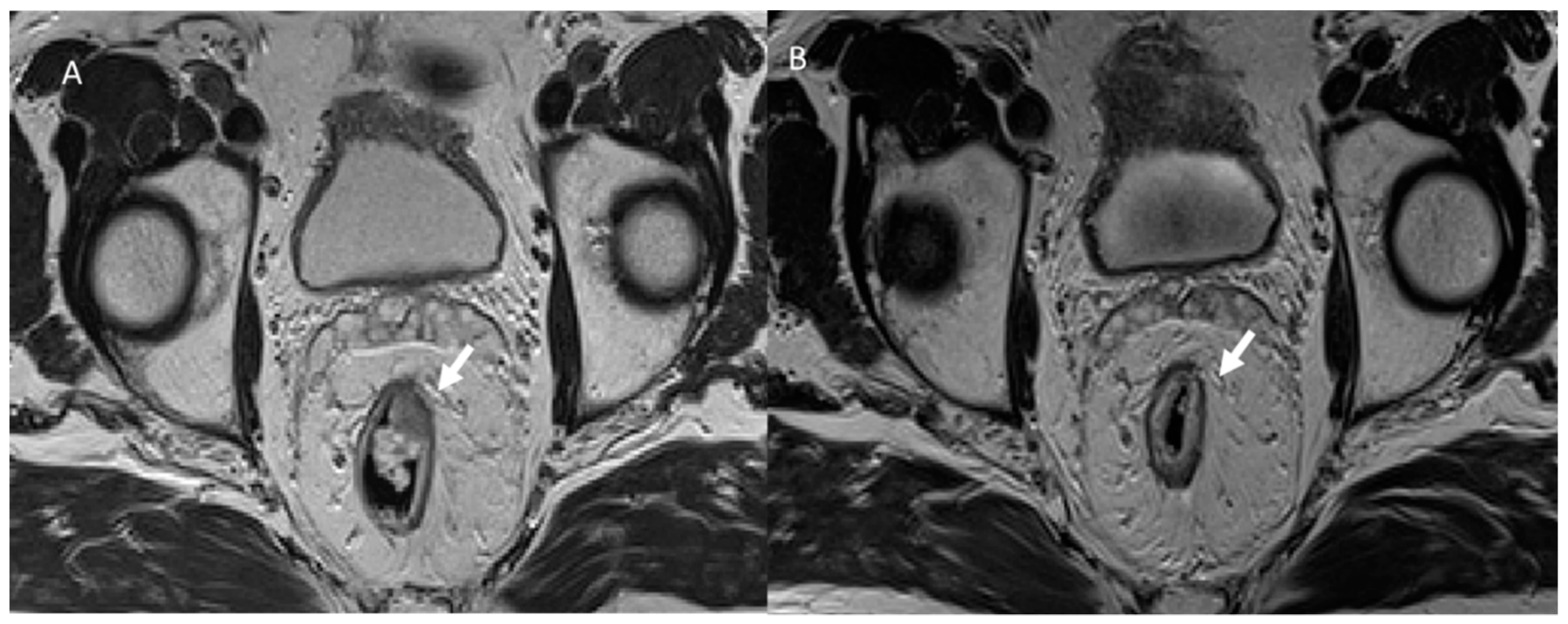 JCM | Free Full-Text | Post-Surgical Imaging Assessment in Rectal Cancer:  Normal Findings and Complications