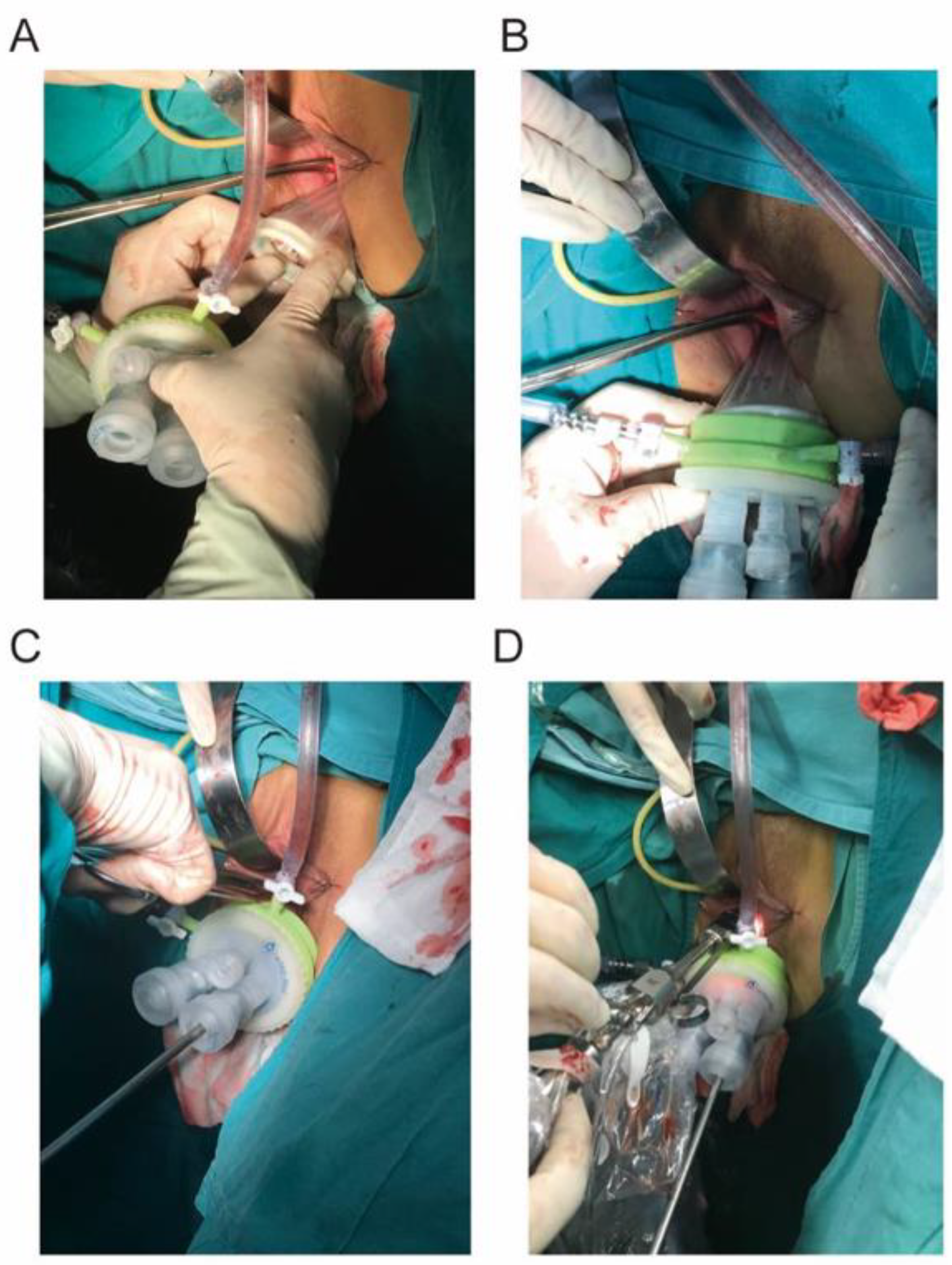 Surgical treatment with complete excision of the mass via a vaginal