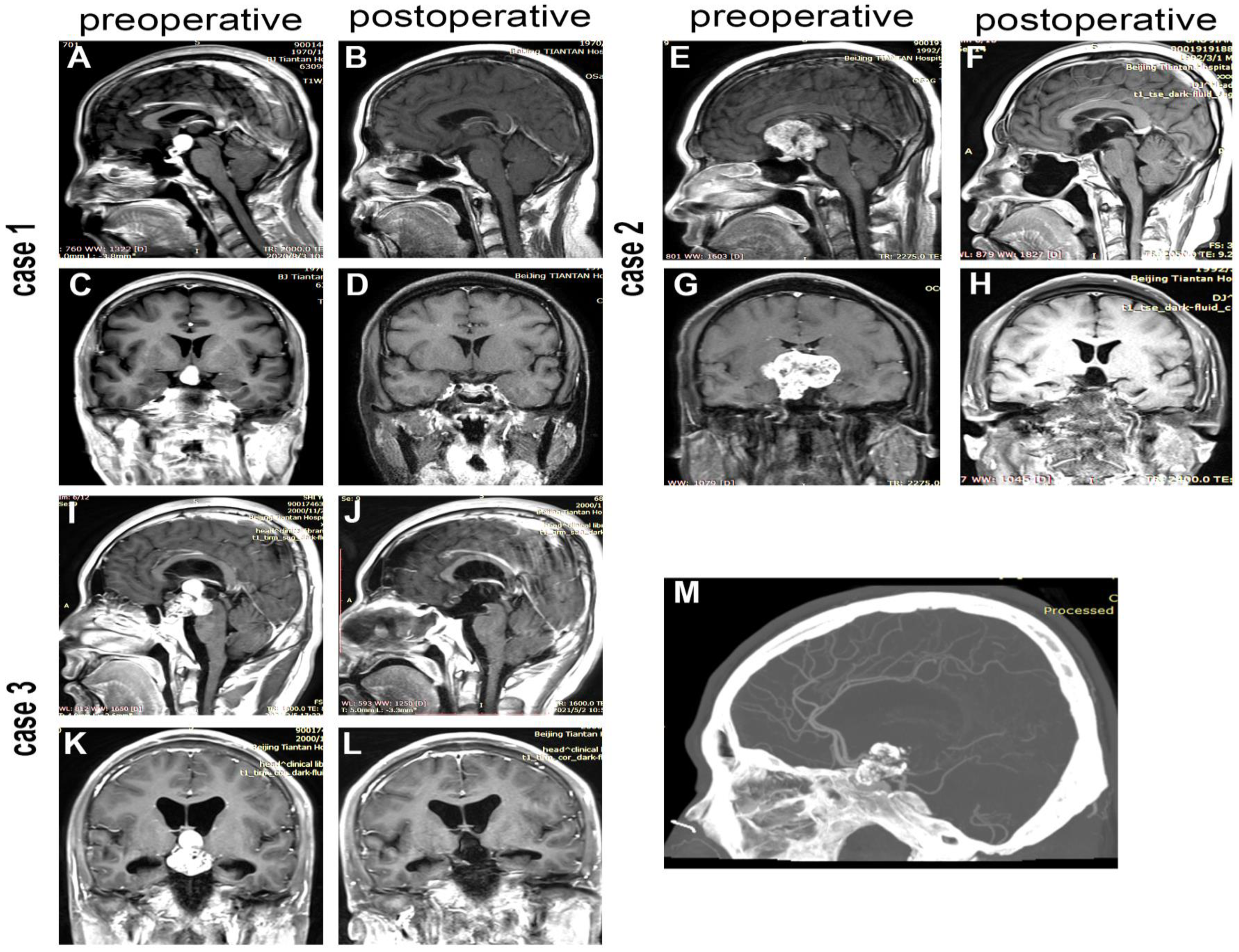 Perioperative Glycemia Management in Patients Undergoing Craniotomy for  Brain Tumor Resection: A Global Survey of Neuroanesthesiologists'  Perceptions and Practices - ScienceDirect