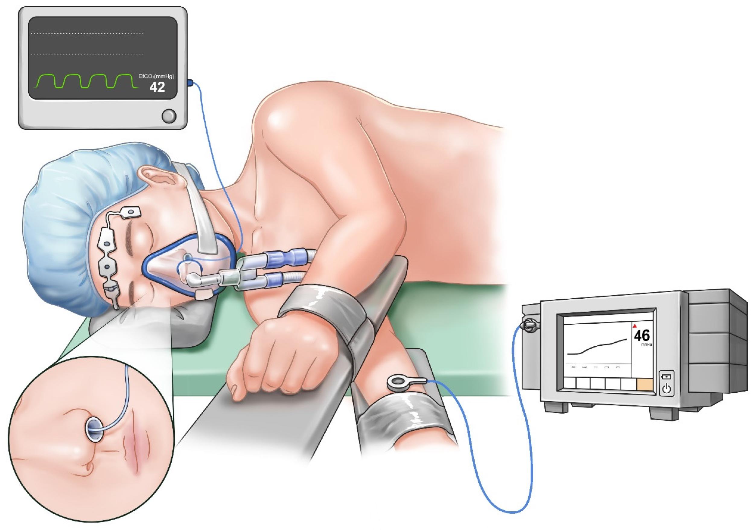 JCM | Free Full-Text | Transcutaneous Carbon Dioxide Monitoring More  Accurately Detects Hypercapnia than End-Tidal Carbon Dioxide Monitoring  during Non-Intubated Video-Assisted Thoracic Surgery: A Retrospective  Cohort Study