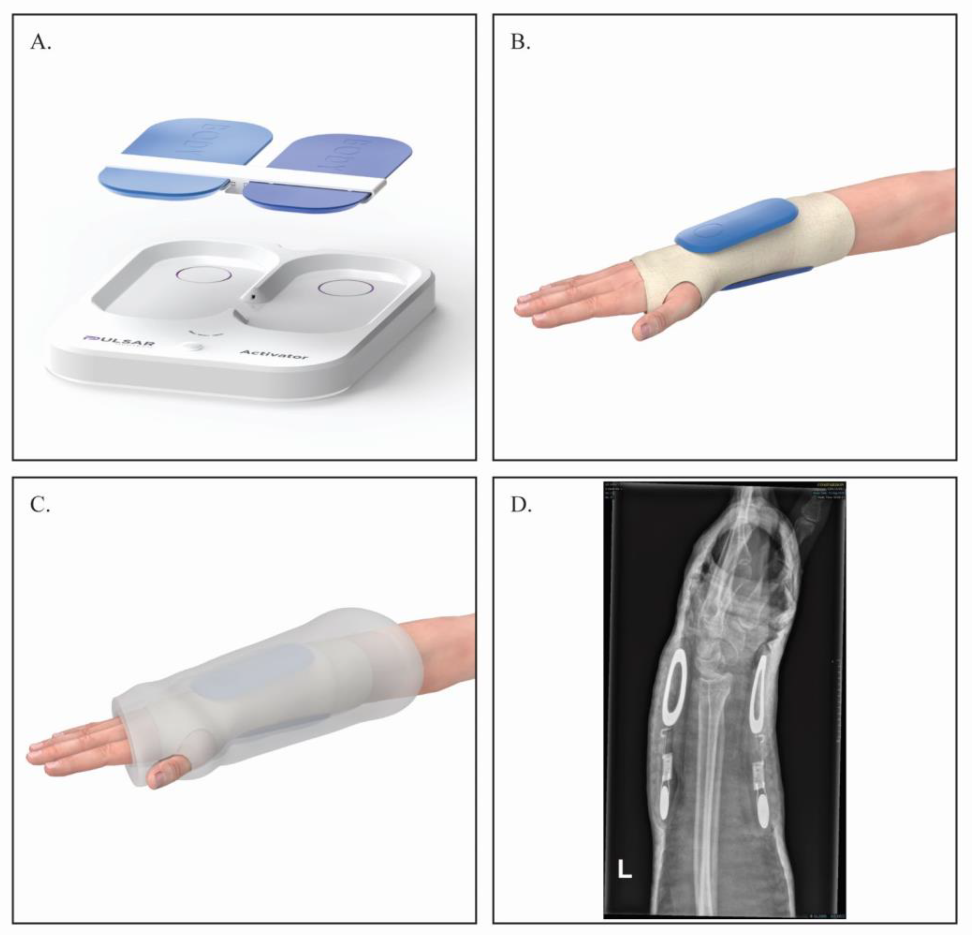 Efficacy of Electrical Stimulators for Bone Healing: A Meta