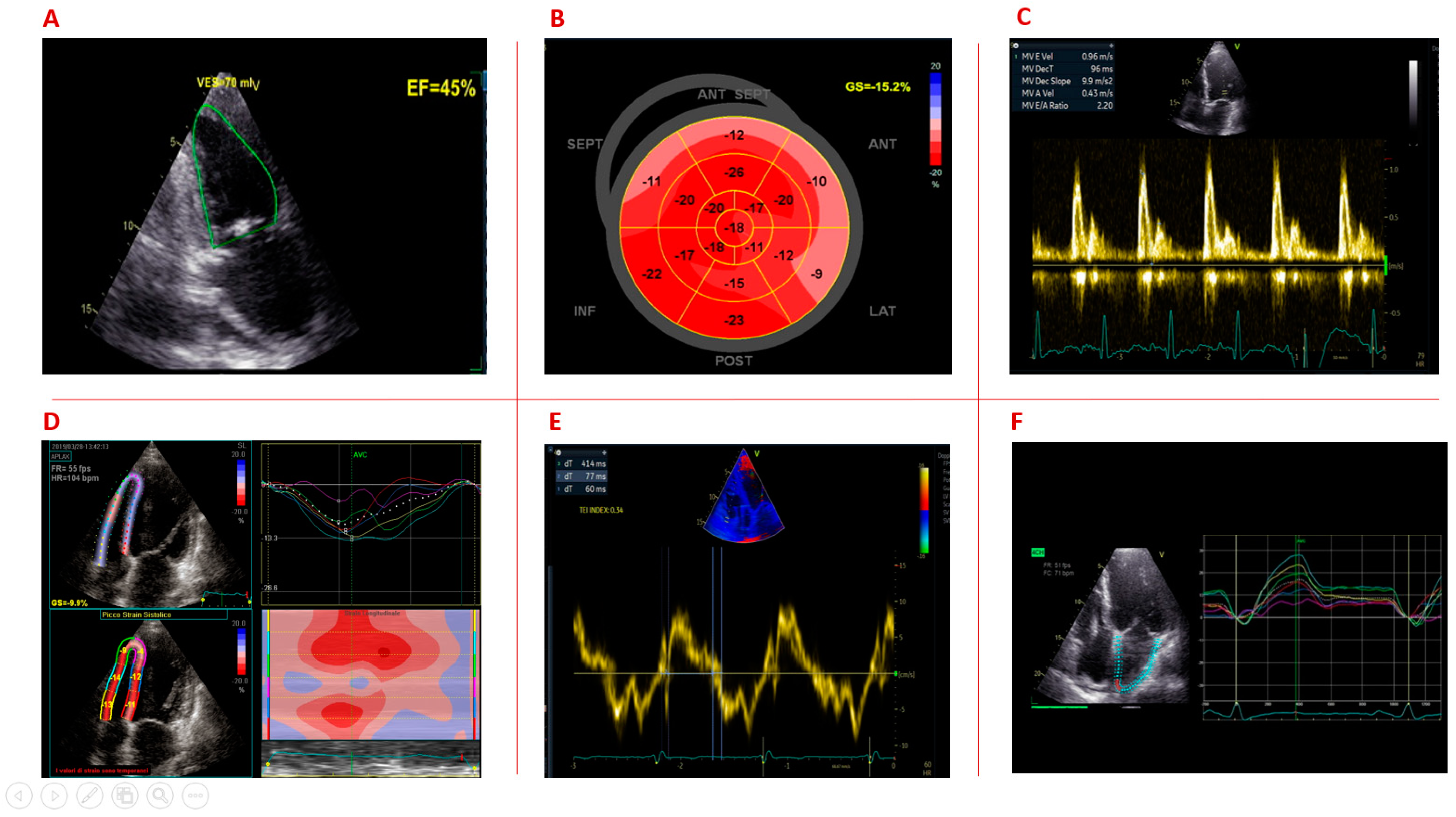 Strain Echocardiography part II: General concept 