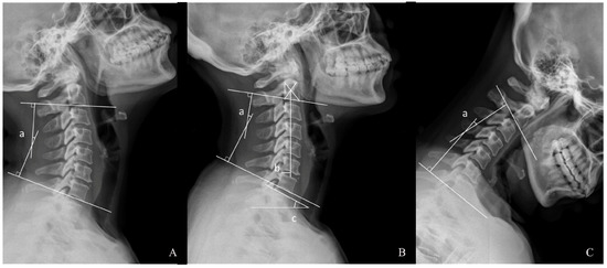 Lateral cervical spine showing C0-C3 fusion in reduced position