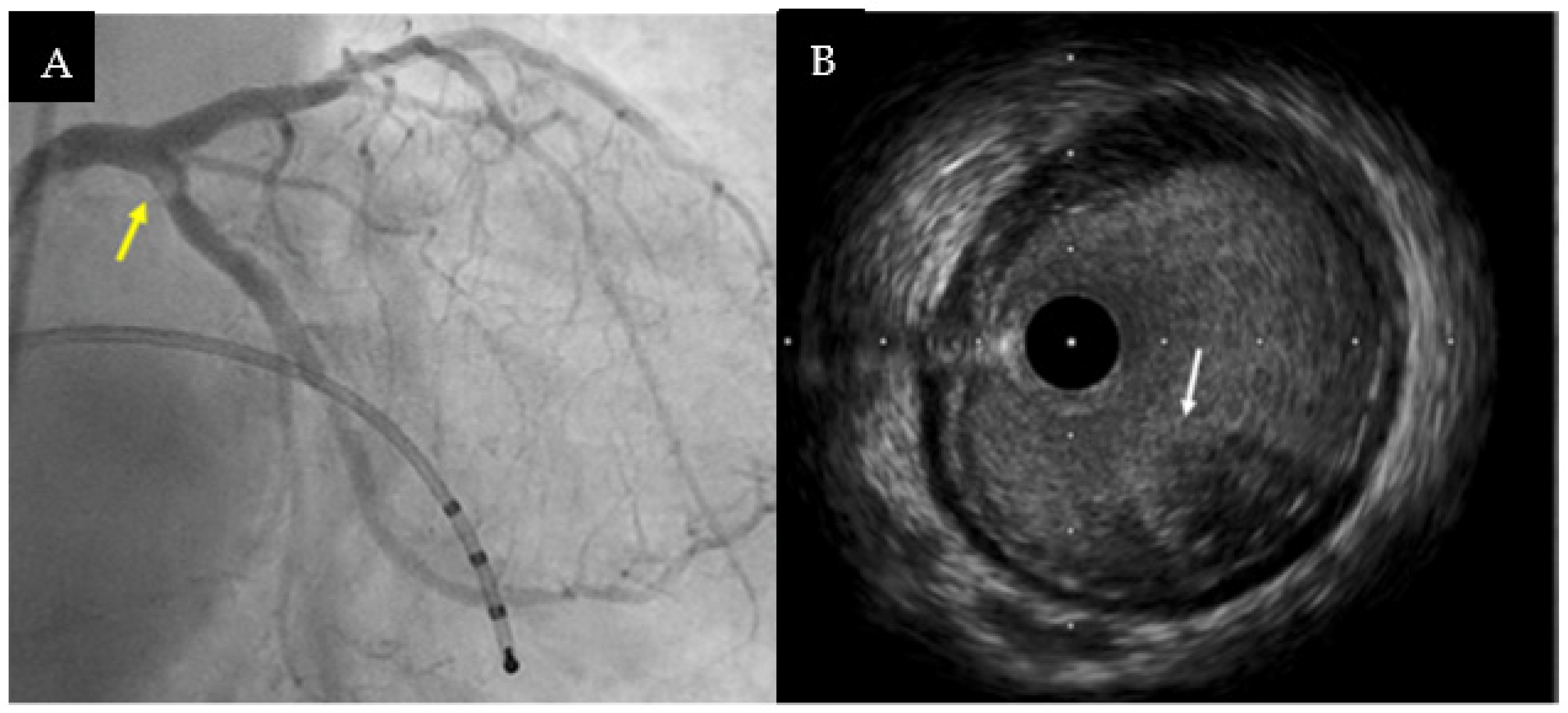 Jcm Free Full Text Role Of Intracoronary Imaging In Myocardial Infarction With Non