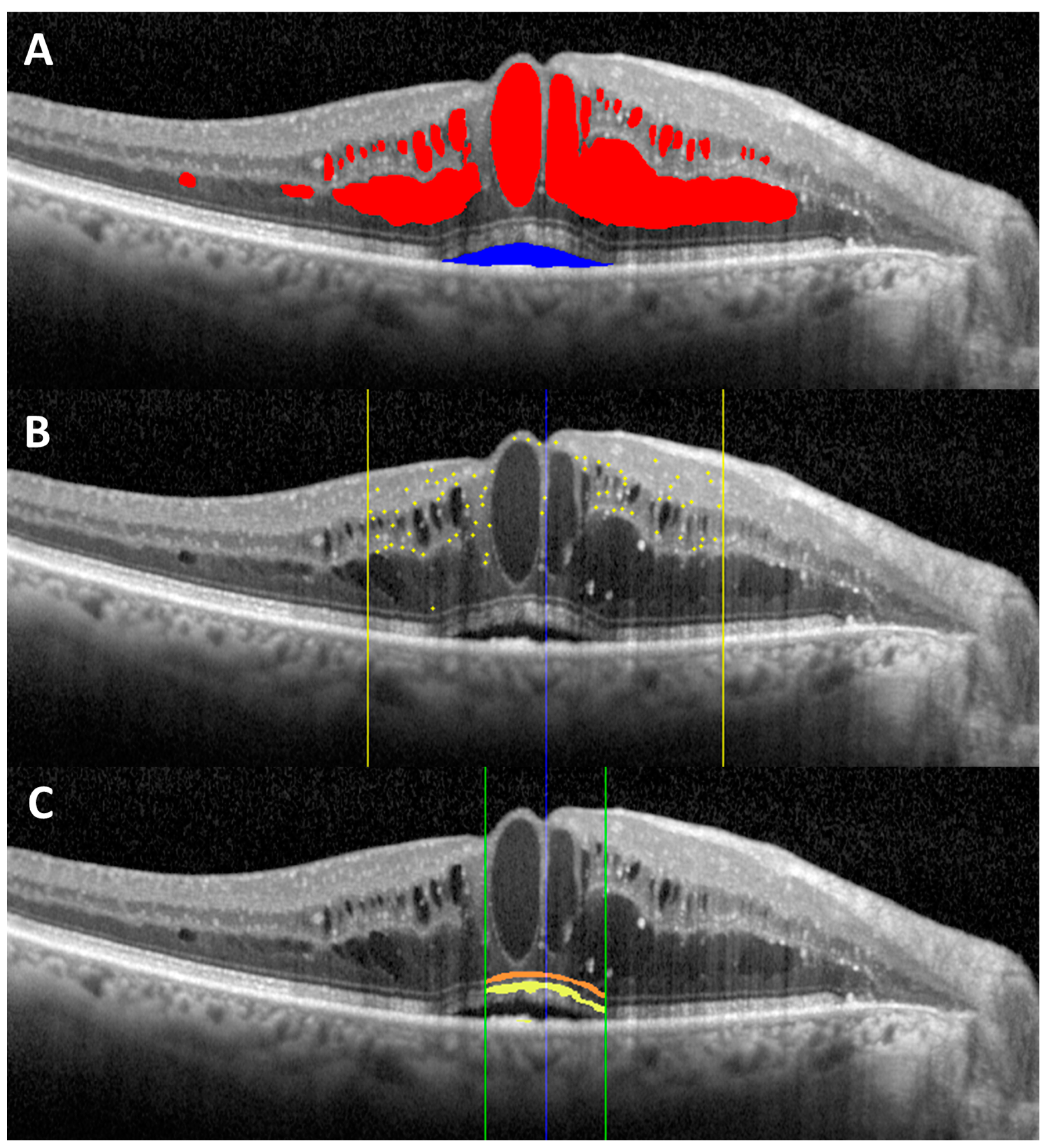 macular edema oct