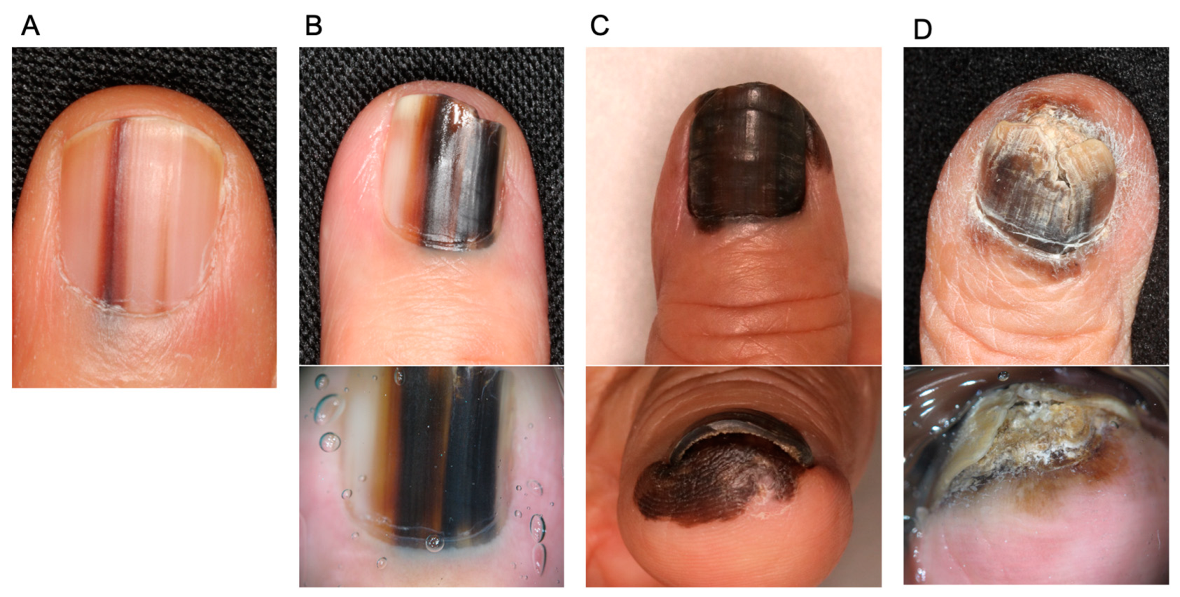Fingernail analysis for early detection and diagnosis of diseases using  machine learning techniques