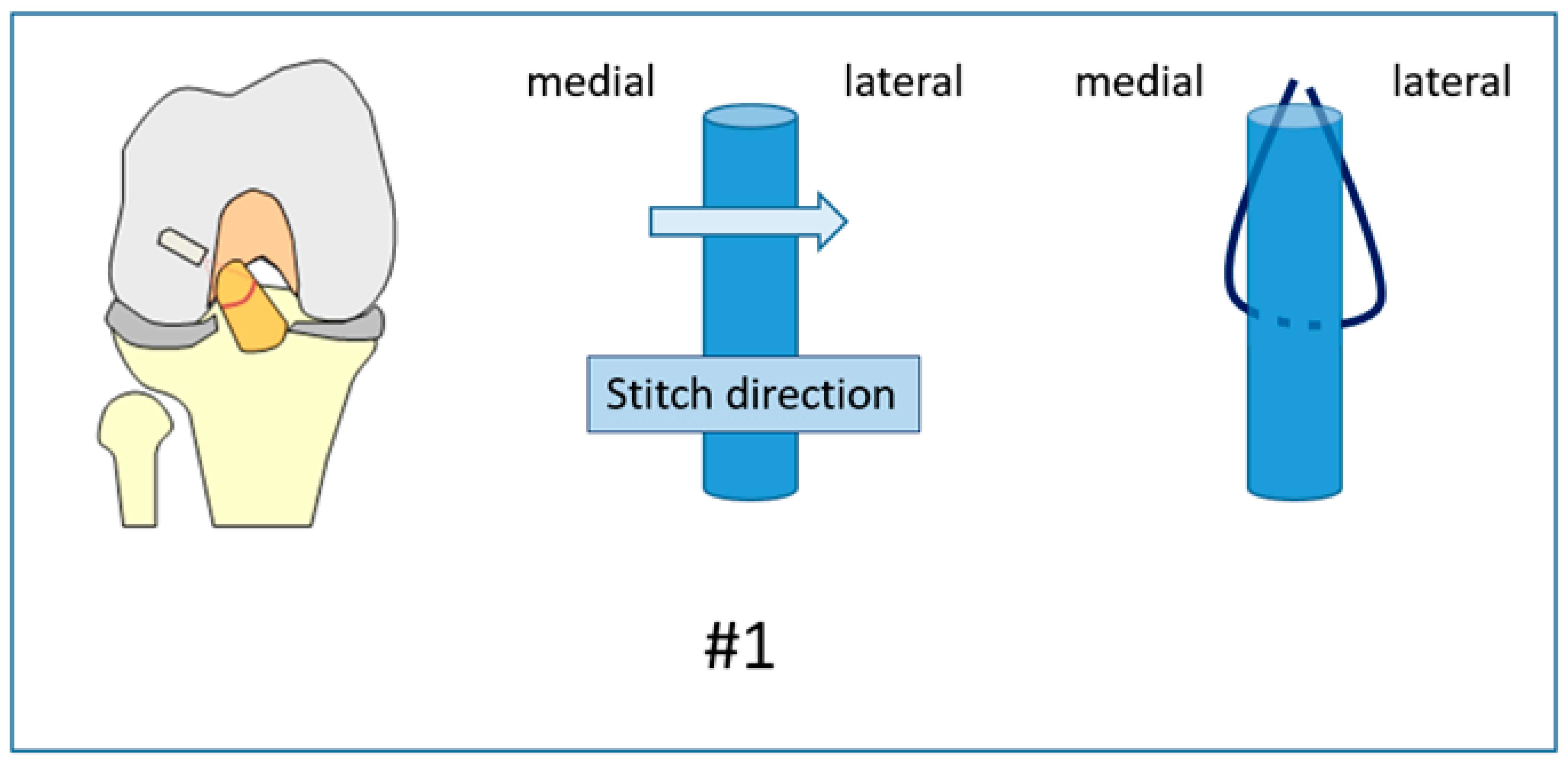 Micro Suture 3 Stitch