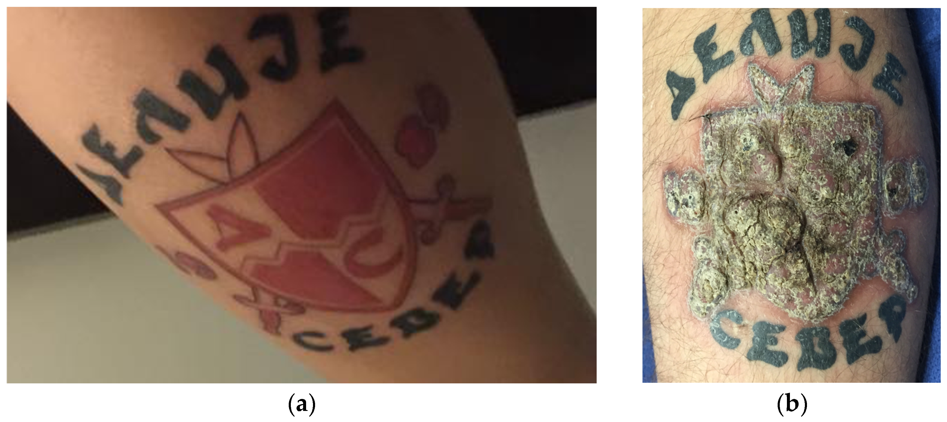 PDF) Tattoo sarcoidosis presenting as abdominal allodynia