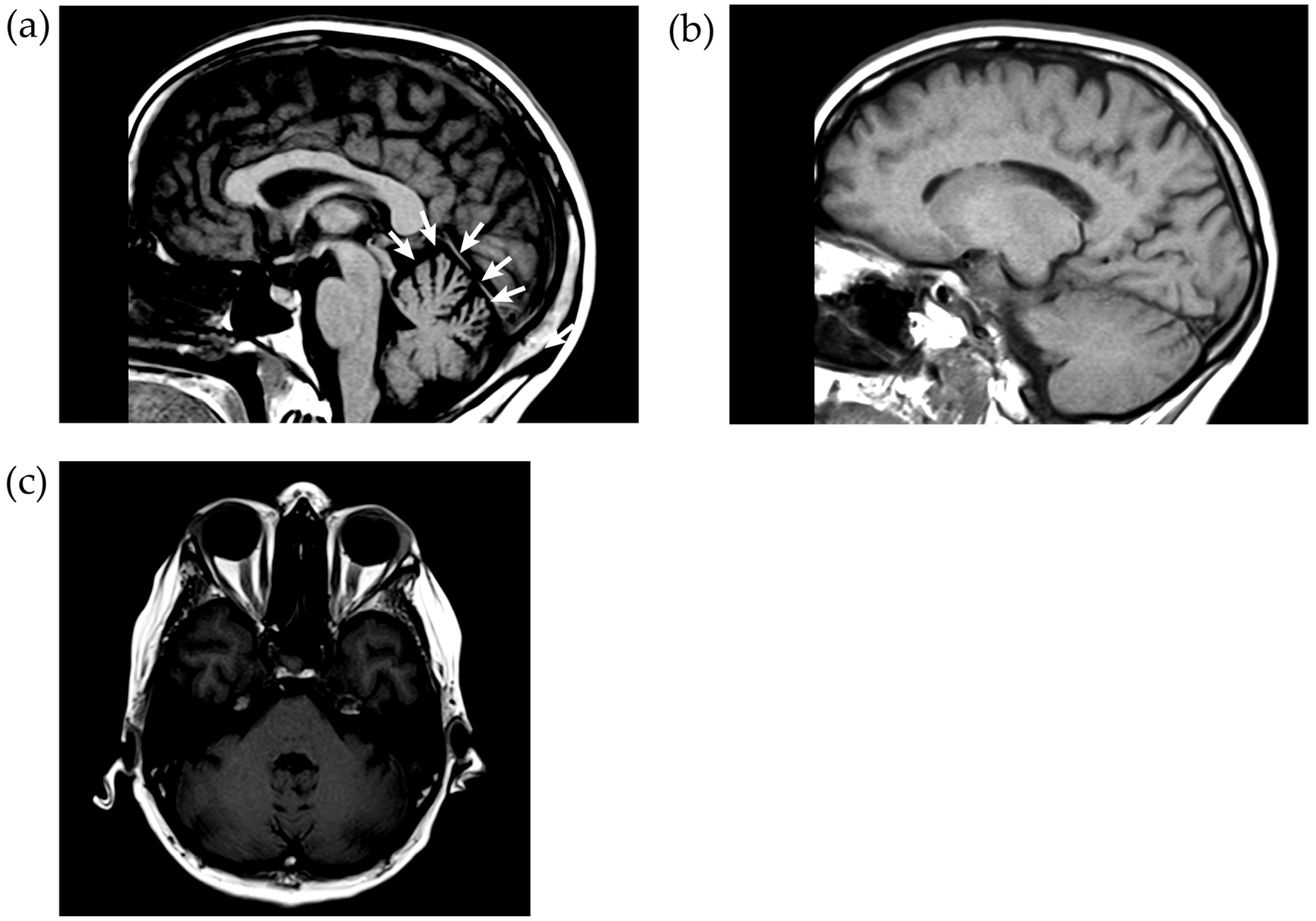 JCM | Free Full-Text | Coordination and Cognition in Pure Nutritional  Wernicke&rsquo;s Encephalopathy with Cerebellar Degeneration after COVID-19  Infection: A Unique Case Report